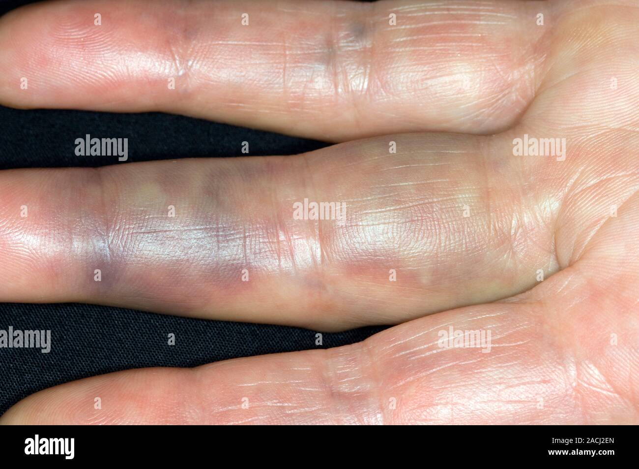 Bluterguss (Hämatom) rund um die gebrochen (zerbrochenen) Mittelfinger in einer 50 Jahre alten Patientin eine Woche nach einem Fall Tennis spielen. Stockfoto