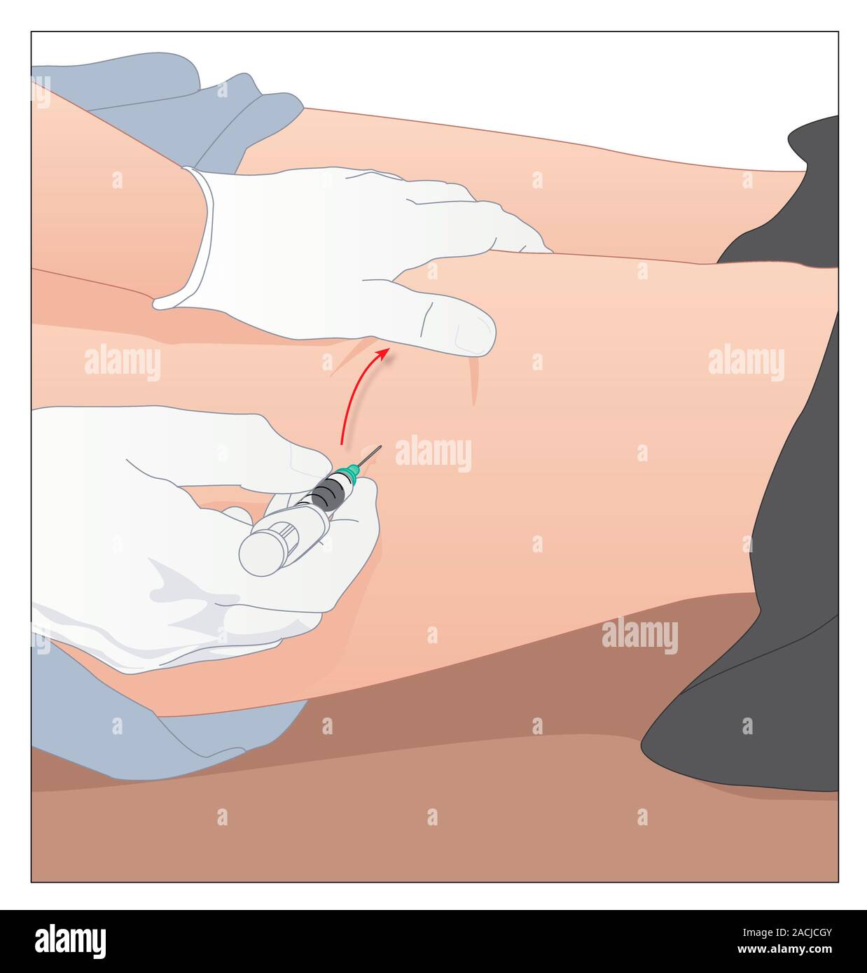 Artwork mit behandschuhten Hände, die Oberschenkel des Patienten während der Injektion in den M. vastus lateralis Website der Extremität, einer Region, in der die großen Beinmuskeln ma Stockfoto