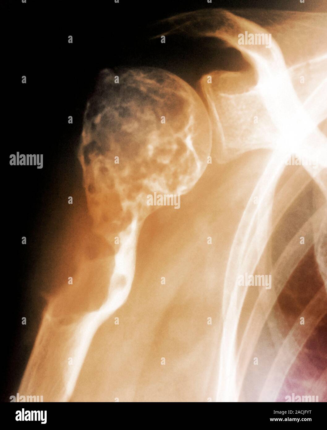Farbige X-Ray (Vorderansicht) der Schulter in einem 65 Jahre alten