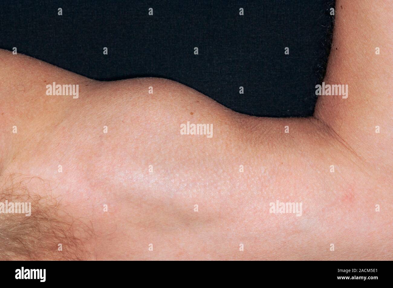Muskel Schwellung im oberen Arm in eine 58-jährige männliche Patient  aufgrund einer gebrochenen Leiter der Bizeps sehnen, die Sehne, die den  Bizeps Muskeln beimisst Stockfotografie - Alamy