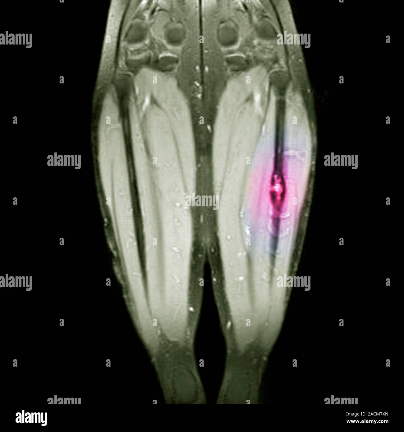 Knochenkrebs. Farbige Magnetresonanztomographie (MRT) Scan der Beine einer 46 Jahre alten Frau mit einem chondrosarkom (rosa) in Ihrer linken Femur (Schenkel b Stockfoto