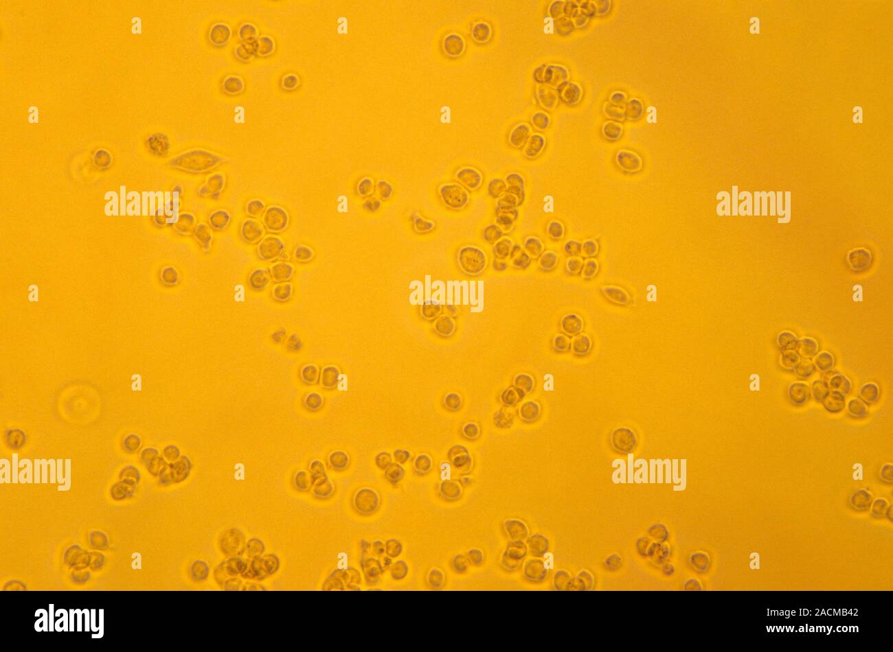 Lymphozyten mit TB-Bakterien infiziert. Licht Schliffbild der