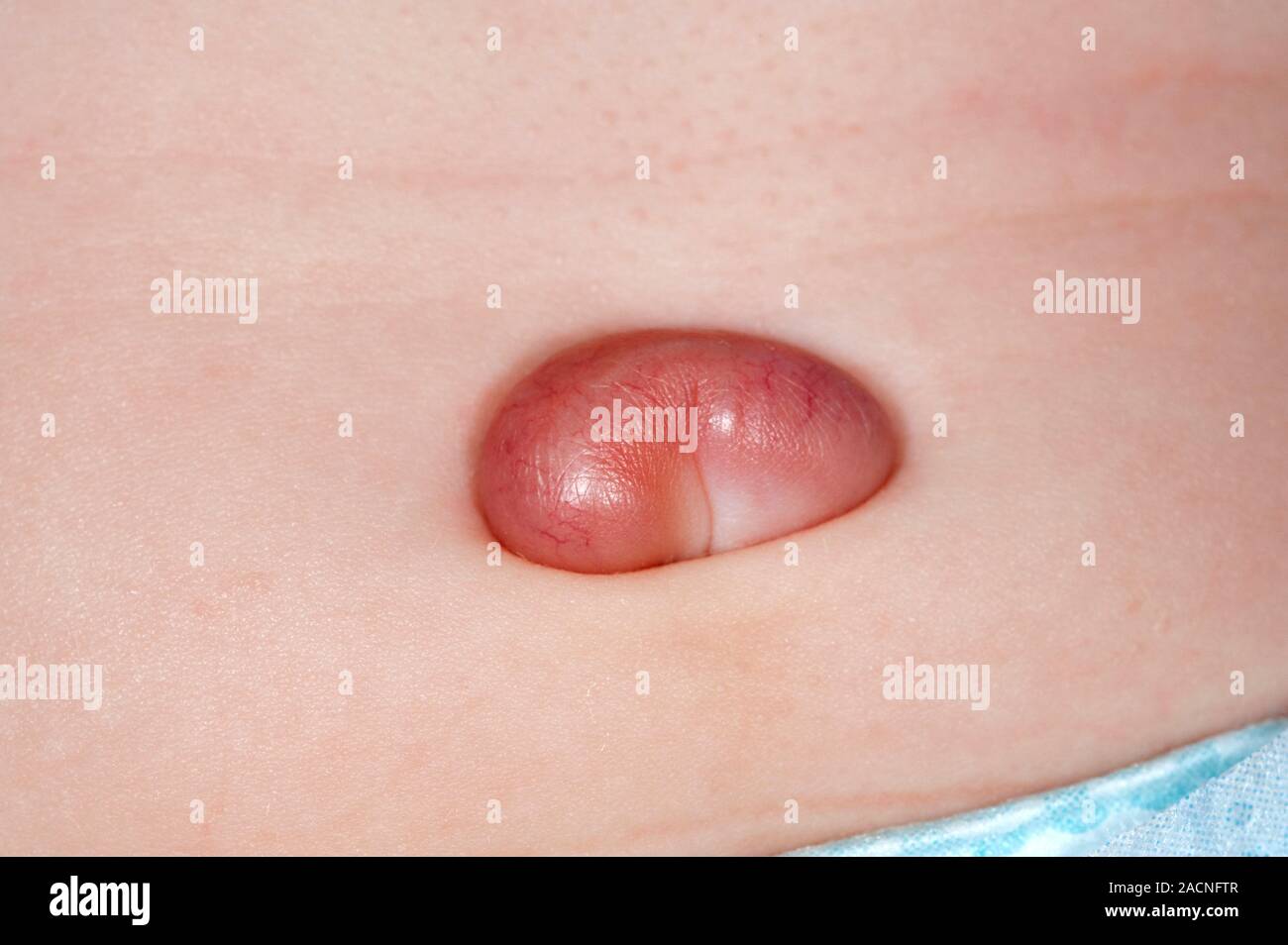 Narbengewebe in den Nabel einer 6 Monate alten männlichen Patienten, bekannt als Nabelschnur Granulom. Es Reizungen verursachen und kann operativ entfernt werden. Stockfoto