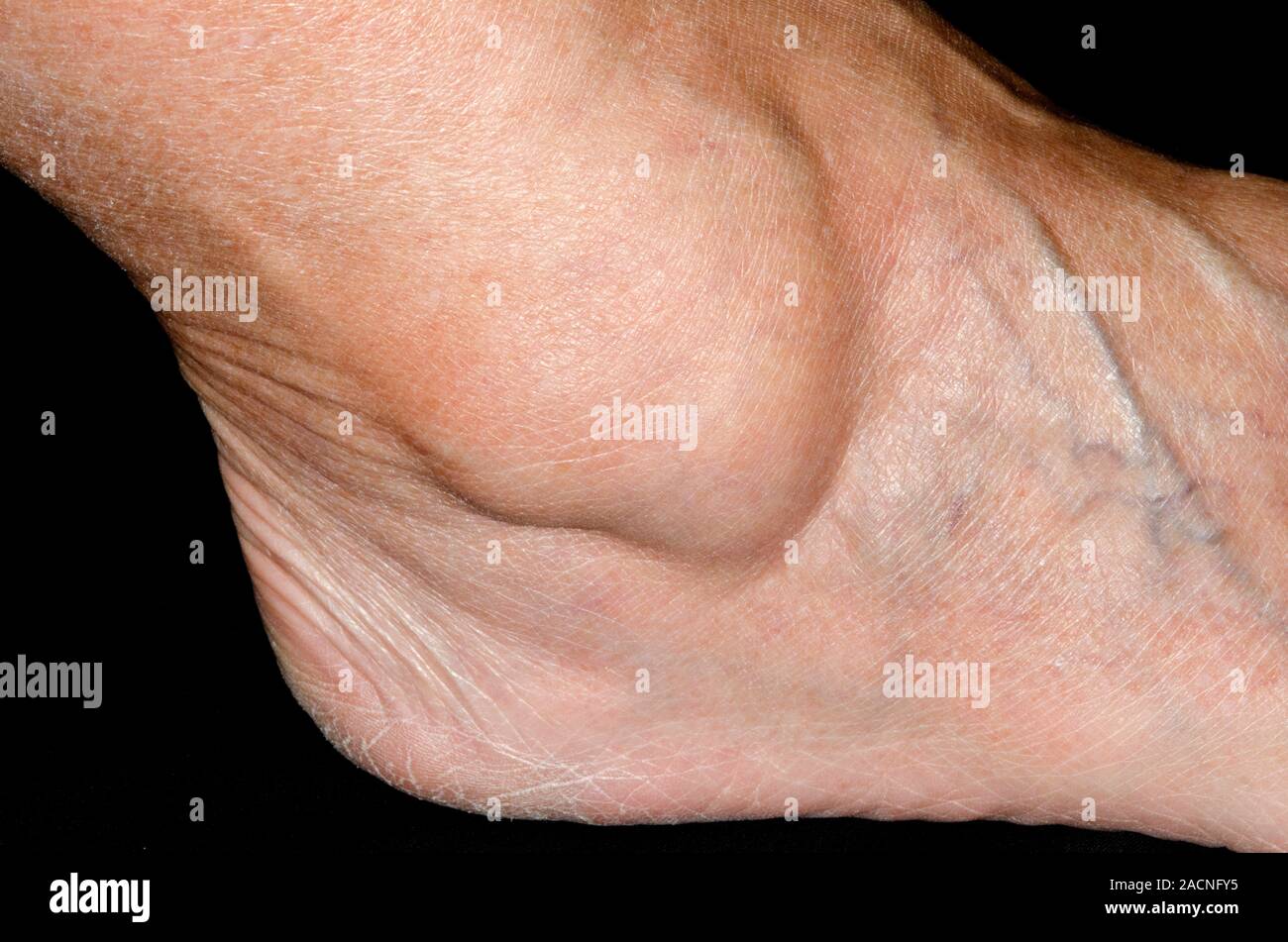 Ganglion Beule Schwellung Unterm Knöchel Außen www.alamy.de