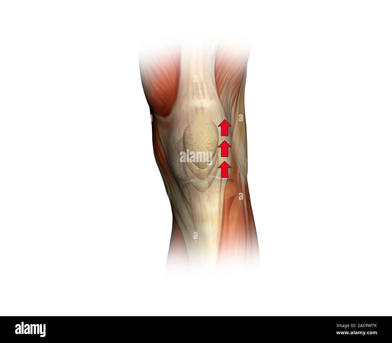 Patella zucken. Artwork der Muskeln des Knies von der Front, die mit einem roten Pfeil zeigt die Richtung der Bewegung der Kniescheibe (Patella), wenn Th Stockfoto