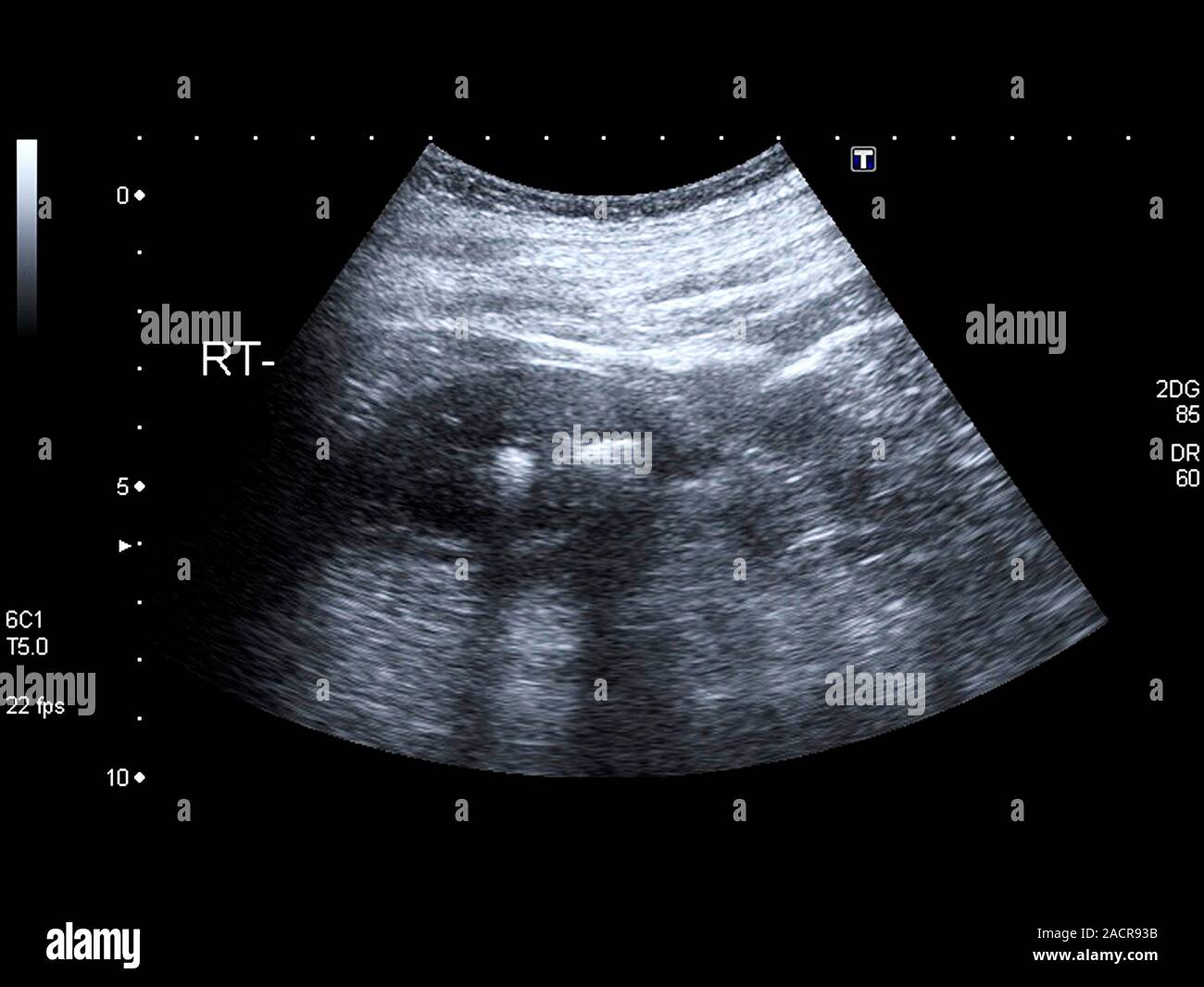 Kann Man Nierensteine Im Ultraschall Sehen www.alamy.de