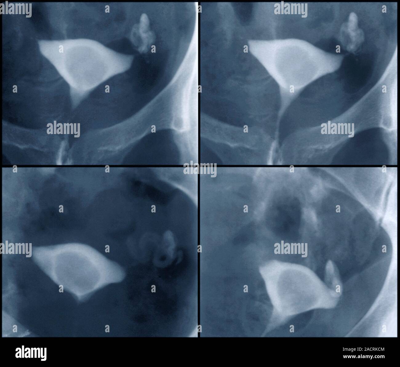 Endometrial Polypen. Farbige hysterosalpingogram XStrahlen des Uterus (Gebärmutter) eines 38