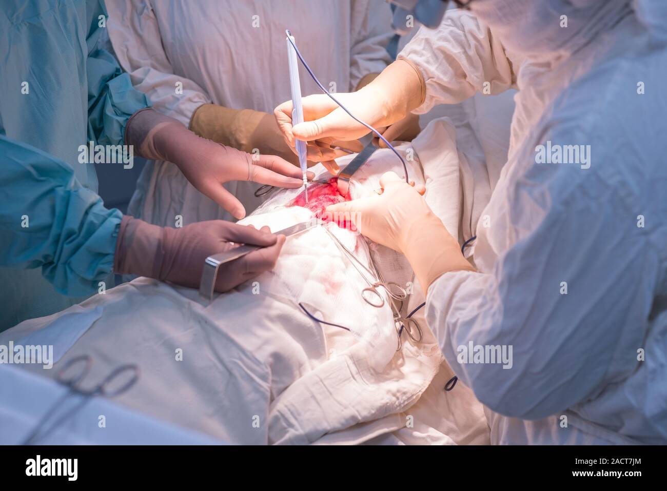 Ärzte - Kinder- Chirurgen, die in einem sterilen Operationssaal, eine Niere Operation durchführen. Der Chirurg Hände halten chirurgische Instrumente, manipulieren Stockfoto