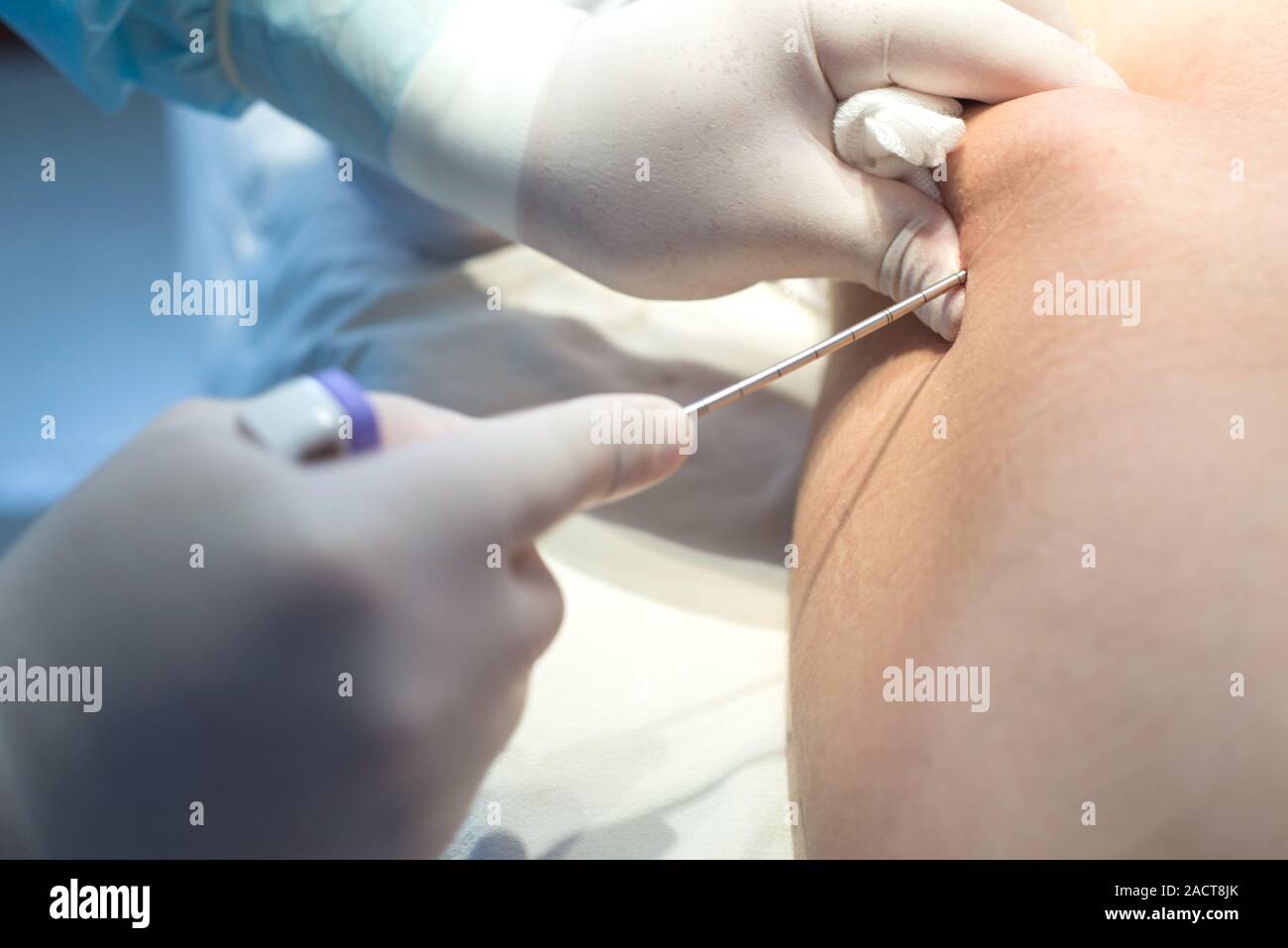 Ein onkologe mit einer langen Nadel durchbohren die childs ileum Knochenmark für Leukämie Ewings Sarkom zu diagnostizieren, Osteomyelitis Knochenerkrankung bei Kinder Stockfoto