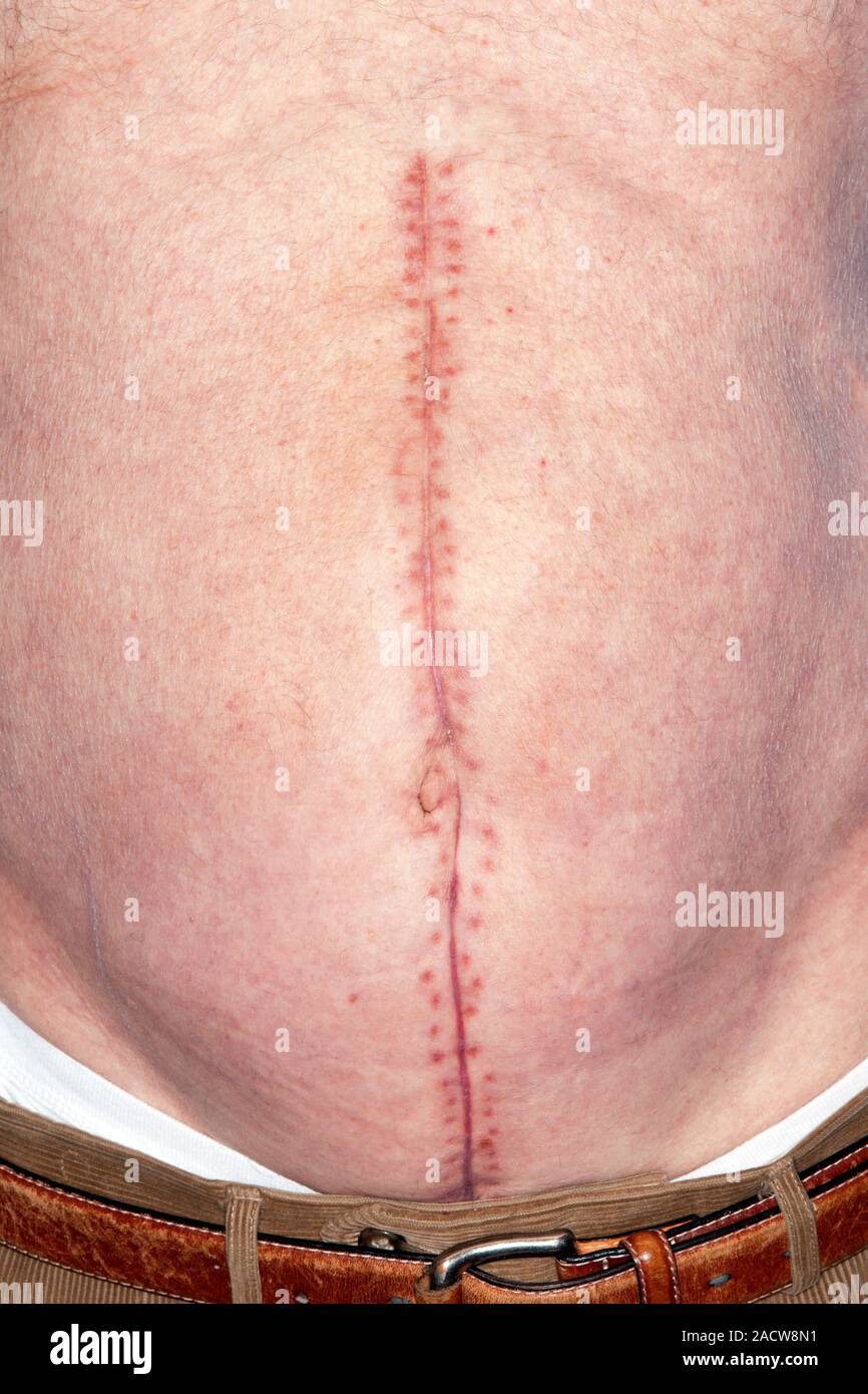 Bilder Von Narben Einer Bauchdeckenstraffung Nach 2 Jahren
