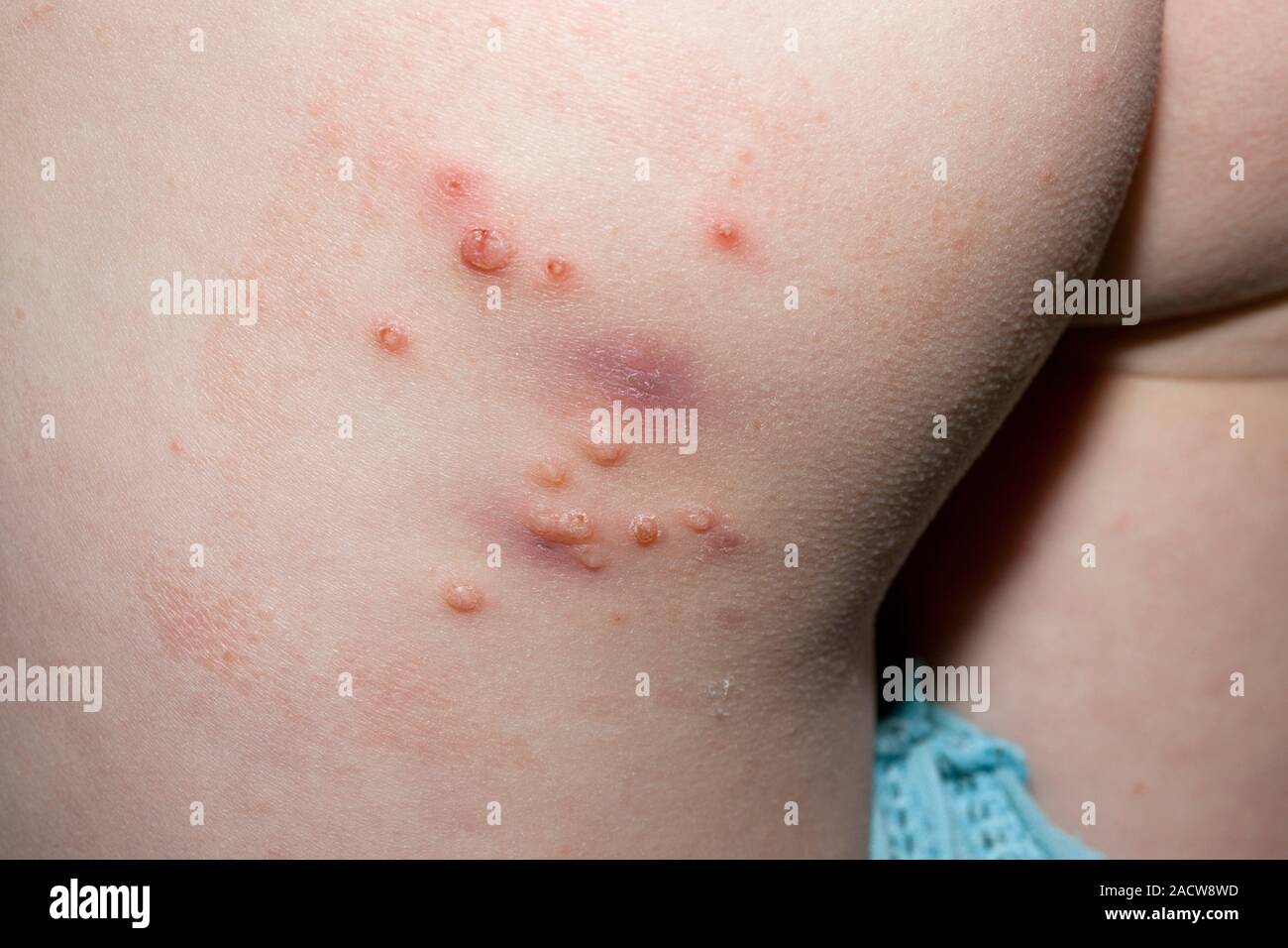 Molluscum contagiosum Infektion. Closeup von der Haut eines 4jährigen