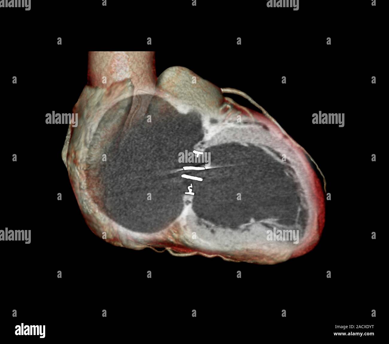 Knstliche Herzklappe. 3D-Computertomographie (CT) der Querschnitt der  Herzen einer 73 Jahre alten Frau. Ein knstliches Herz val Stockfotografie  - Alamy