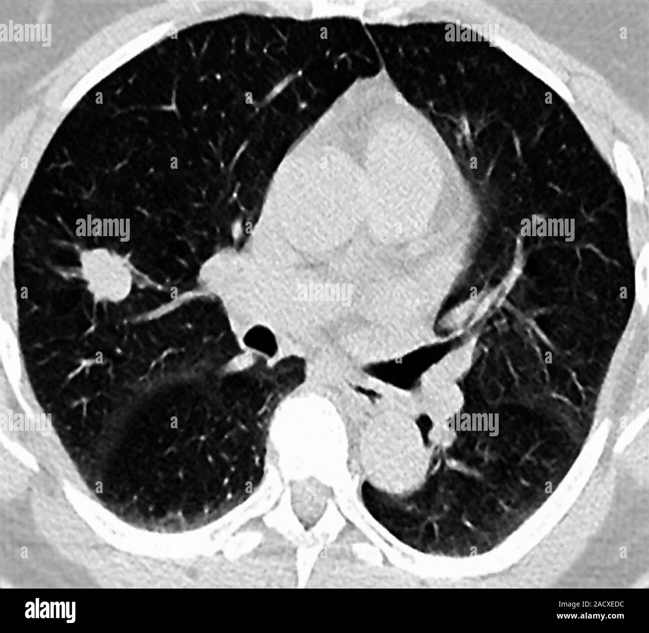 Lungenkrebs. Computertomographie (CT) Untersuchung der Brust (von unten) eine 58 Jahre alte Frau. Eine intravenöse jodhaltigen Kontrastmittel injiziert wurde Stockfoto