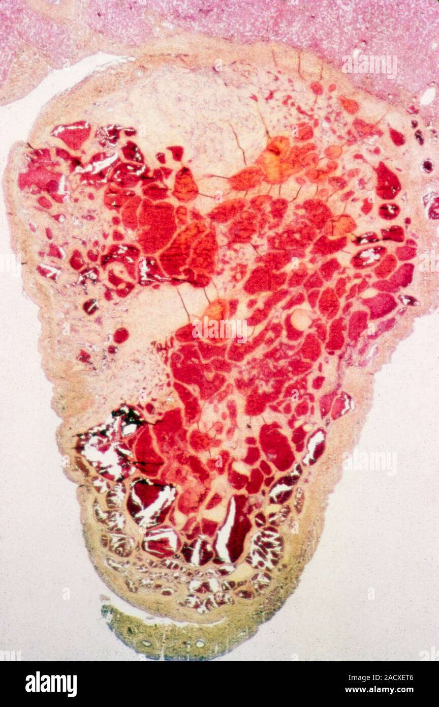 Schnitt durch eine Leber haemangioma, Licht schliffbild. Eine Leber