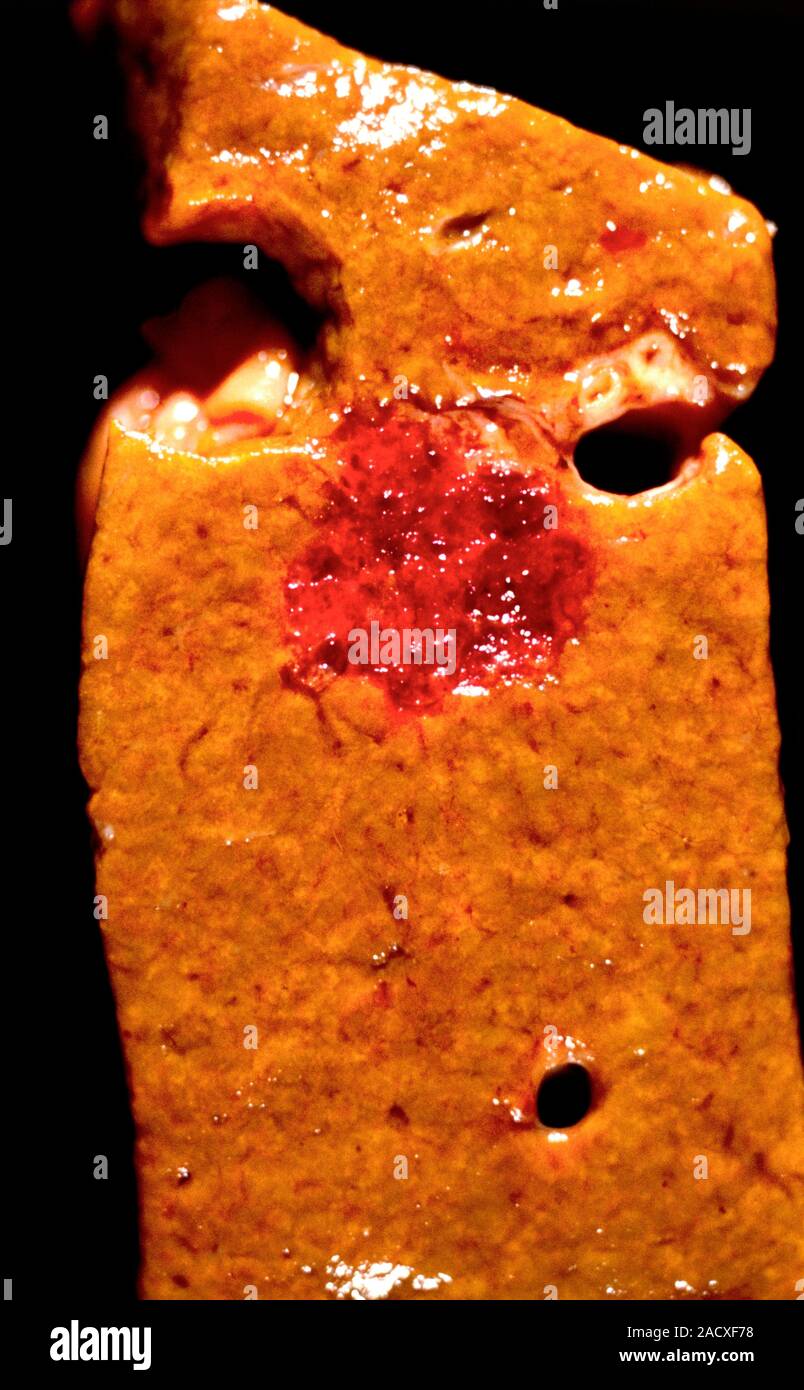 Leber haemangioma, grobe Muster. Eine Leber haemangioma ist ein