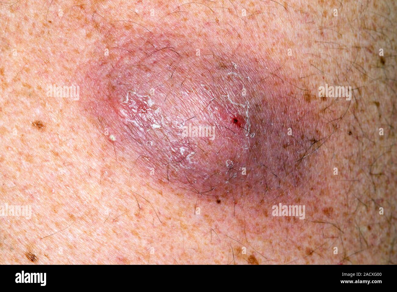 In der Nähe von infizierten sebaceous Zyste auf der Rückseite eines 54  Jahre alten männlichen Patienten. Ein sebaceous Zyste ist ein SAC-wie  Schwellungen unter der Haut gefüllt mit sebu Stockfotografie - Alamy