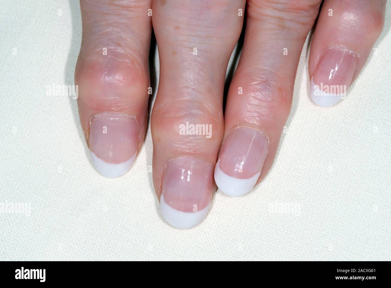 Der heberden Knoten in den Fingern. Eine 68 Jahre alte Frau die Hand ...