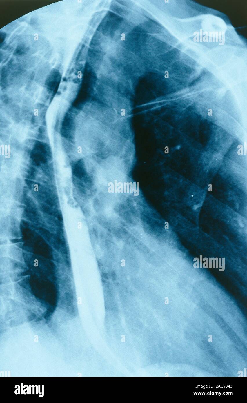 Normale Speiseröhre. Barium X-ray zeigt eine gesunde Speiseröhre (links