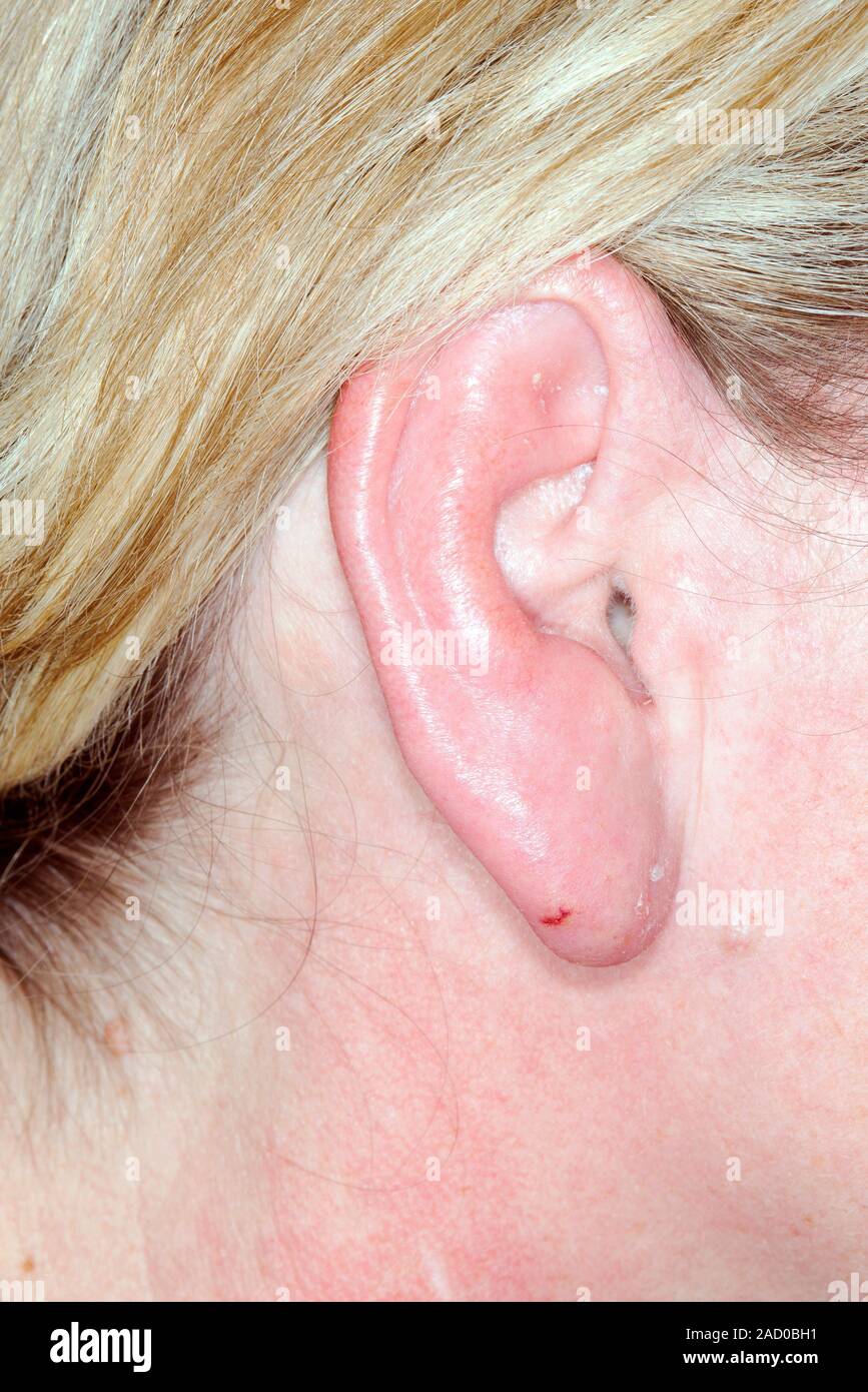 Cellulitis des Ohrs. Close-up von cellulitis, die das Ohr eines 54-jährigen Patientin. Cellulitis ist eine bakterielle Infektion der Haut und ich Stockfoto