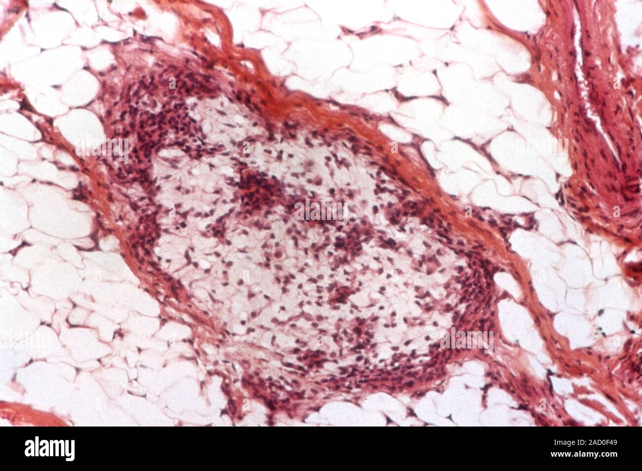 Speicheldrüsen Krebs. Licht Schliffbild einer Sektion durch einen malignen (bösartigen) Tumor in der Ohrspeicheldrüse. Stockfoto