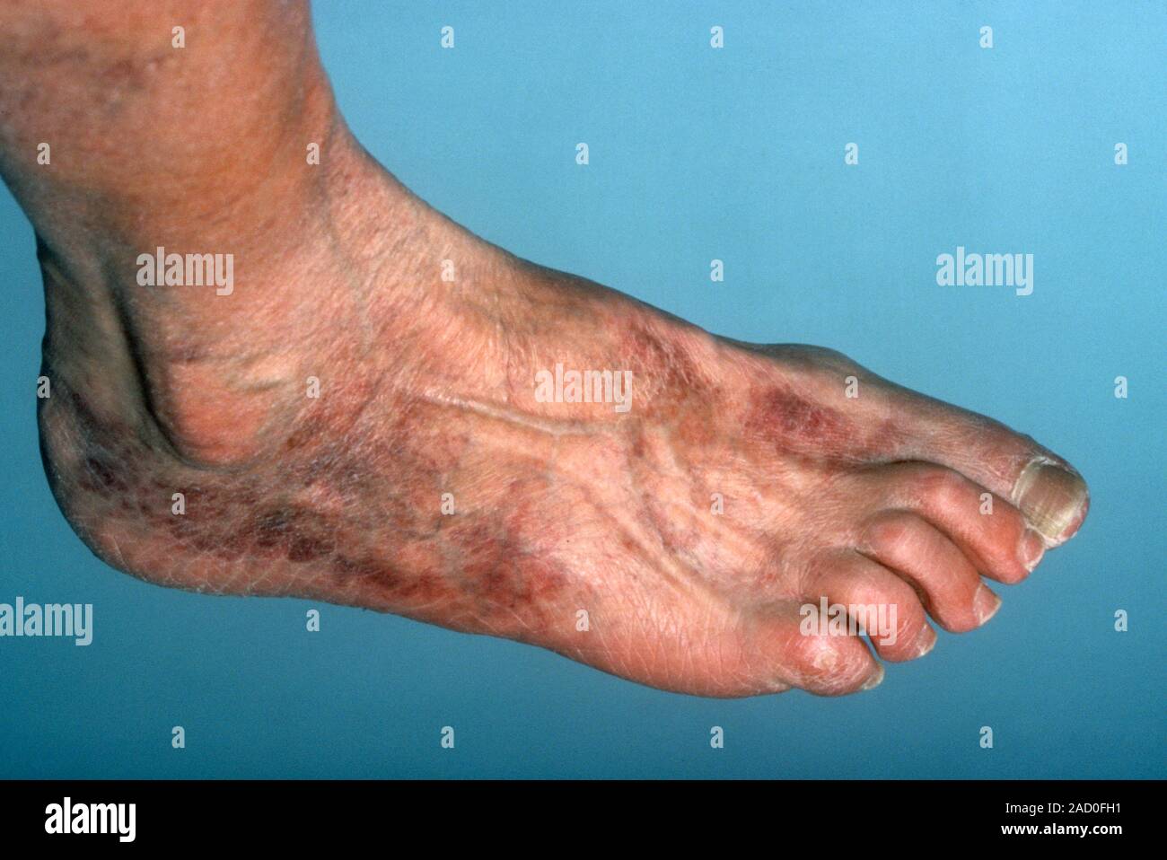 Ischämie des Fußes. Nahaufnahme der Fuß eines Patienten beeinträchtigt durch Ischämie. Ischämie ist eine mangelnde Durchblutung für Teile des Körpers, die durch Text Stockfoto