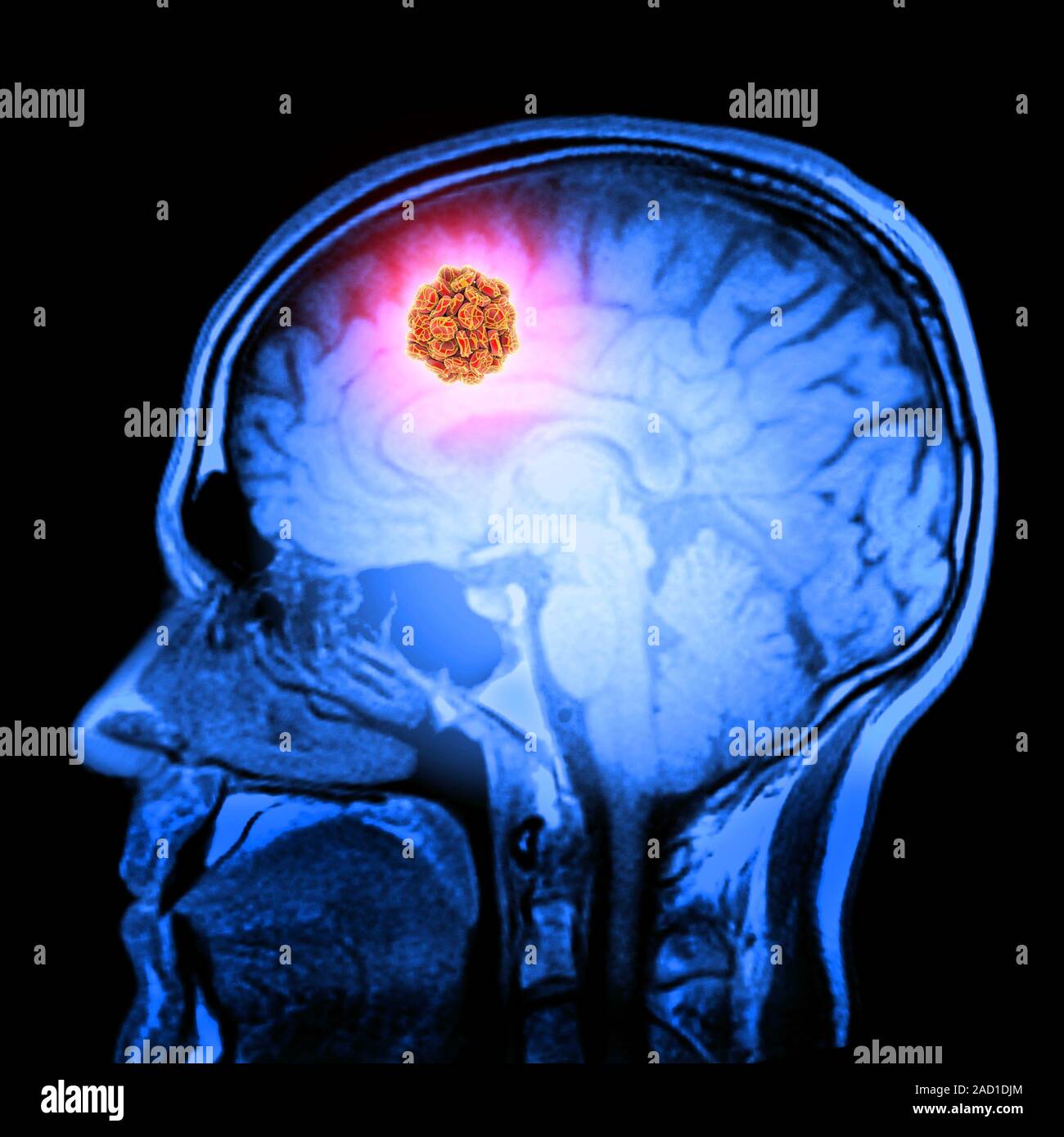 Schlaganfall, MRT-Scan des Gehirns. Computer Artwork von einem Blutgerinnsel oder thromben überzog ein MRI-brain Scan (magnetische Resonanz Scan), zeigen einen Schlaganfall. Red bloo Stockfoto