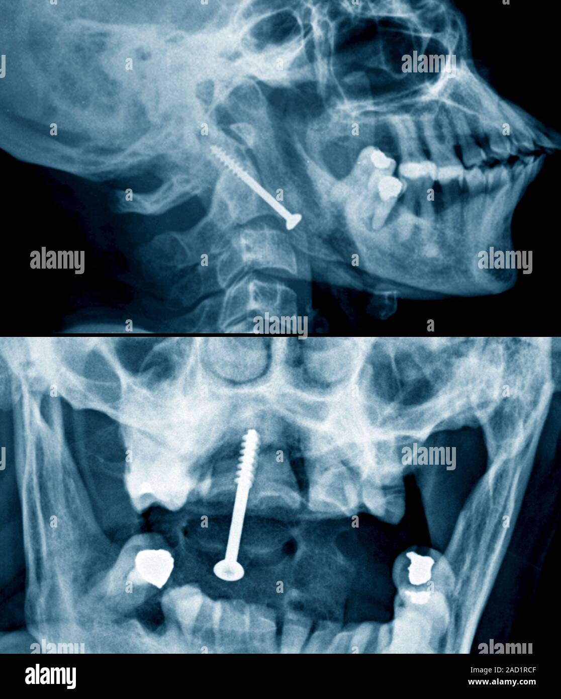 Pinned Genickbruch. Profil (oben) und vorderen (unten) X-Strahlen von einem Abschnitt durch den Kopf und den Hals eines 61-jährigen Patienten mit einer Fraktur des C Stockfoto