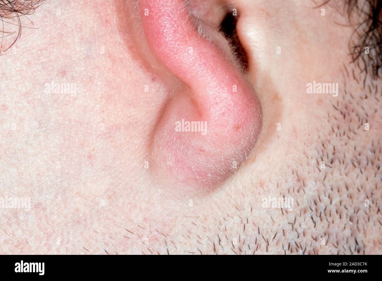 Der talgdrüsen. Nahaufnahme von roten Haut um ein sebaceous Zyste auf das ohrläppchen eines 24-jährigen männlichen Patienten. Ein sebaceous Zyste ist ein SAC-wie Schwellungen unter Th Stockfoto