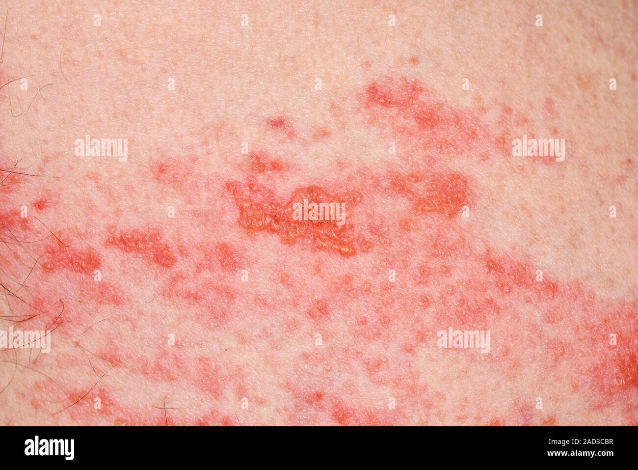 Gürtelrose Hautausschlag. Nahaufnahme einer Ausschlag auf der Haut eines 69-jährigen männlichen Patienten mit Gürtelrose (Herpes zoster). Gürtelrose ist eine Krankheit, die durch die varicel Stockfoto
