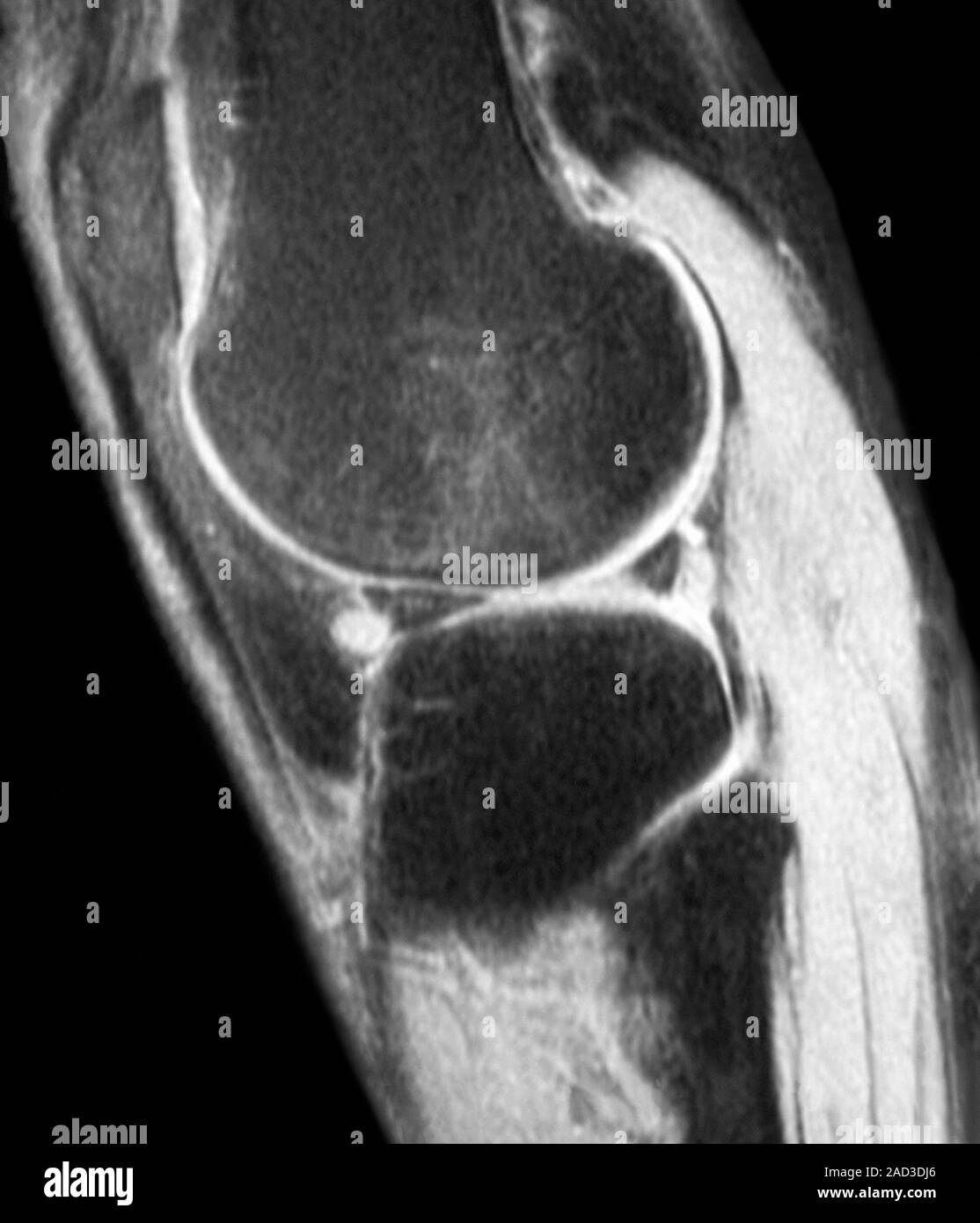 Knie Zyste. Die Magnetresonanztomographie (MRT) Scan eines