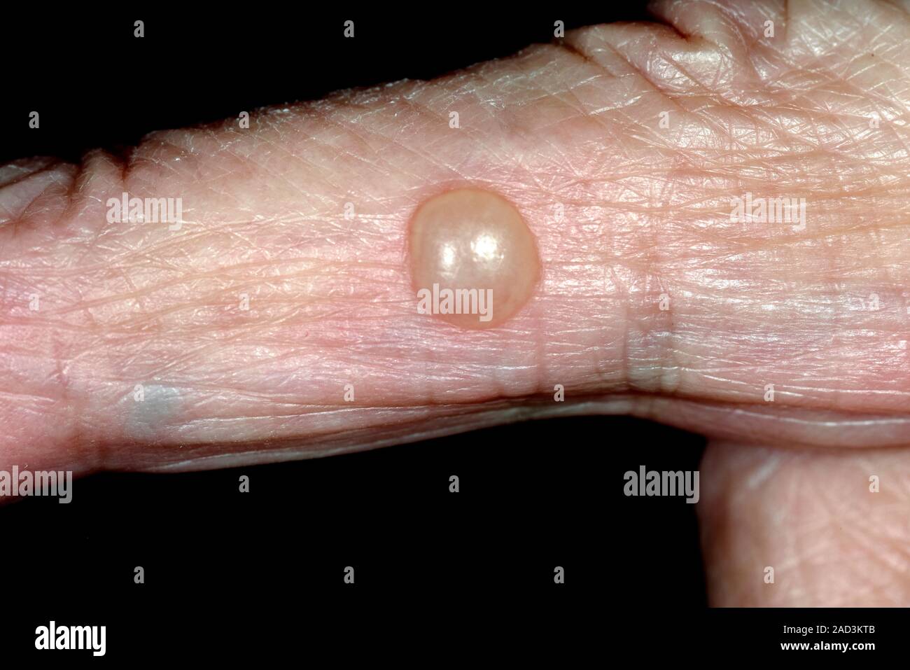 Plötzlich Blase Auf Der Haut www.alamy.de