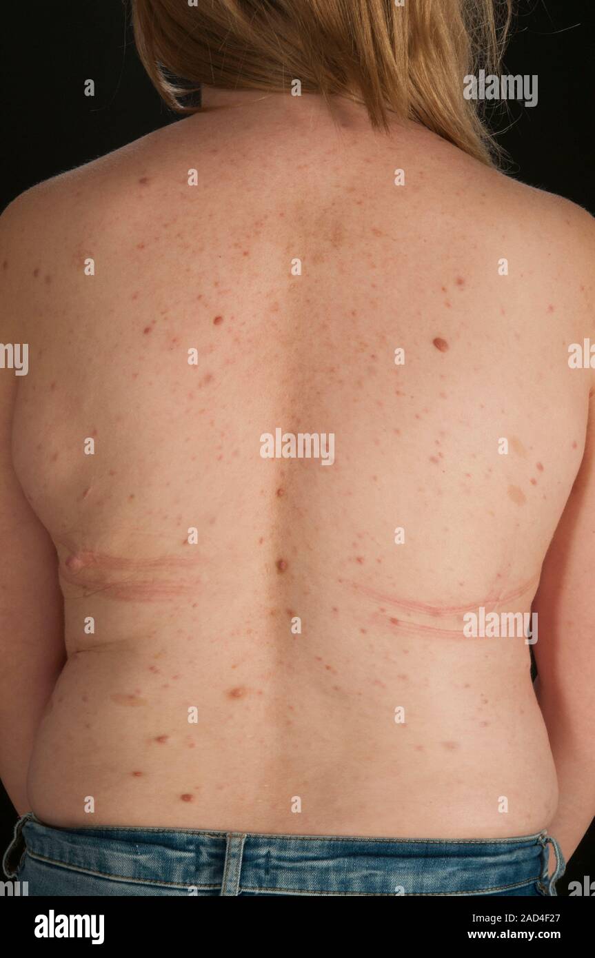 Neurofibromatose. Neurofibroma Wucherungen und Cafe au lait-Flecken auf der Rückseite einer 17-jährigen Patientin mit neurofibromatose. Neurofibromatose i Stockfotografie