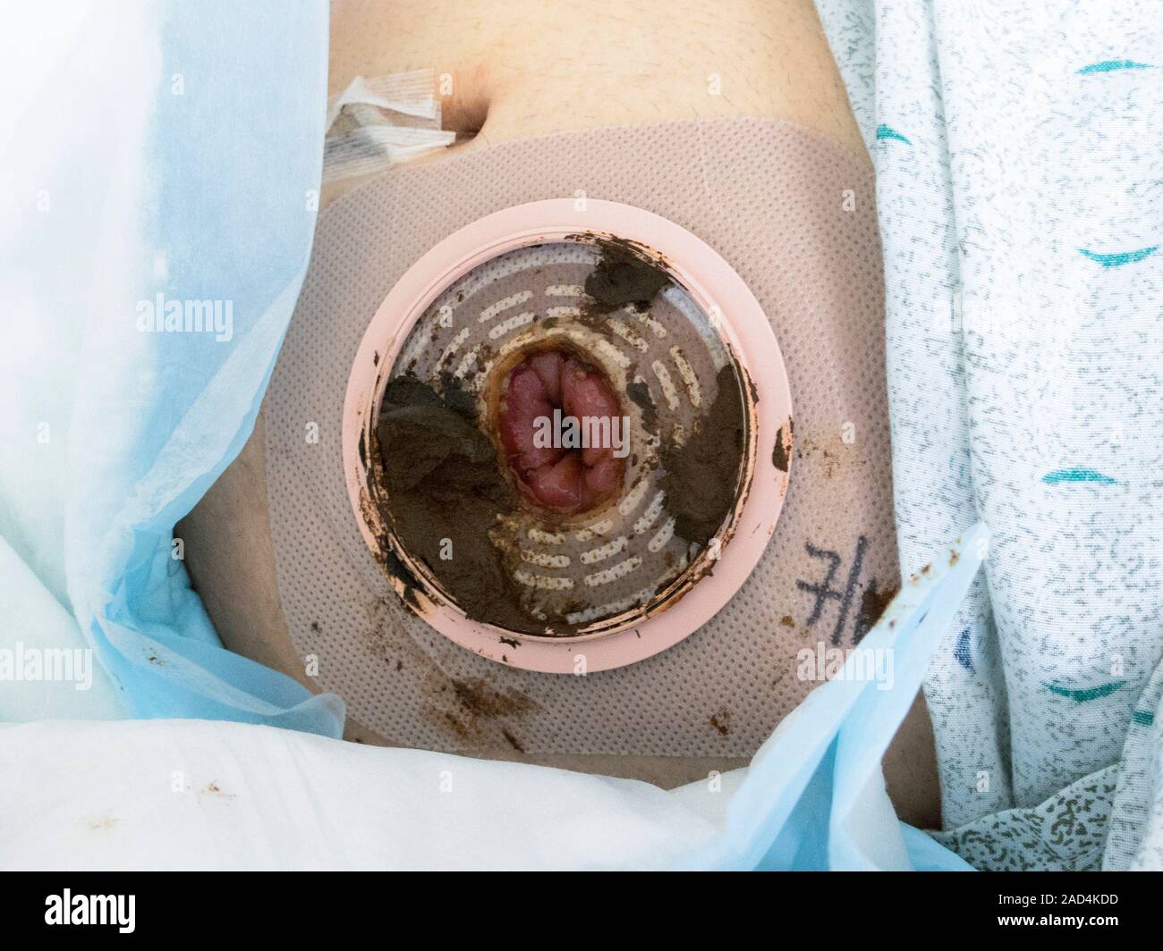 Knstlicher darmausgang Outlet- und Fkal- Einlagen. Freiliegende  Grundplatte der ein knstlicher Darmausgang mit dem stoma in der Mitte und  fkale Einlagen. Ein knstlicher Darmausgang ist eine Operation in Wh  Stockfotografie - Alamy