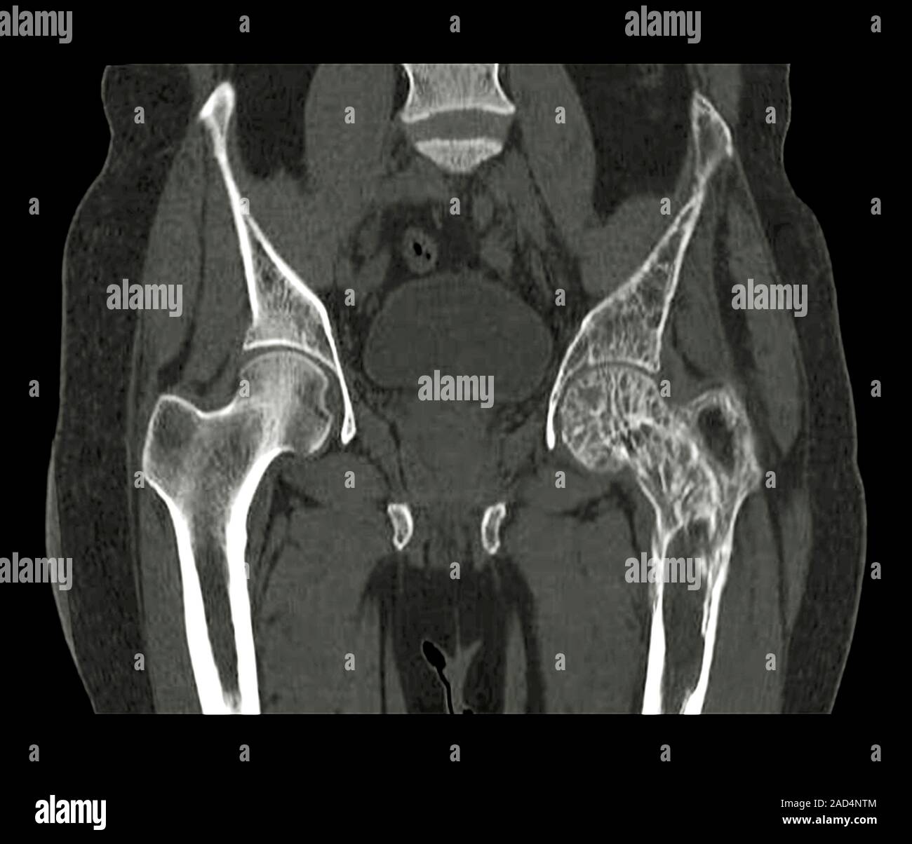 Hüften beim Morbus Paget. Computertomographie (CT)Scan der