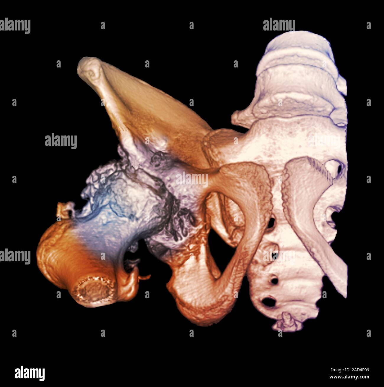 Arthrose der Hfte. 3D-Computertomographie (CT)-Scan der rechten Hfte  eines 57-jhrigen Patienten mit fortgeschrittener Arthrose Stockfotografie  - Alamy