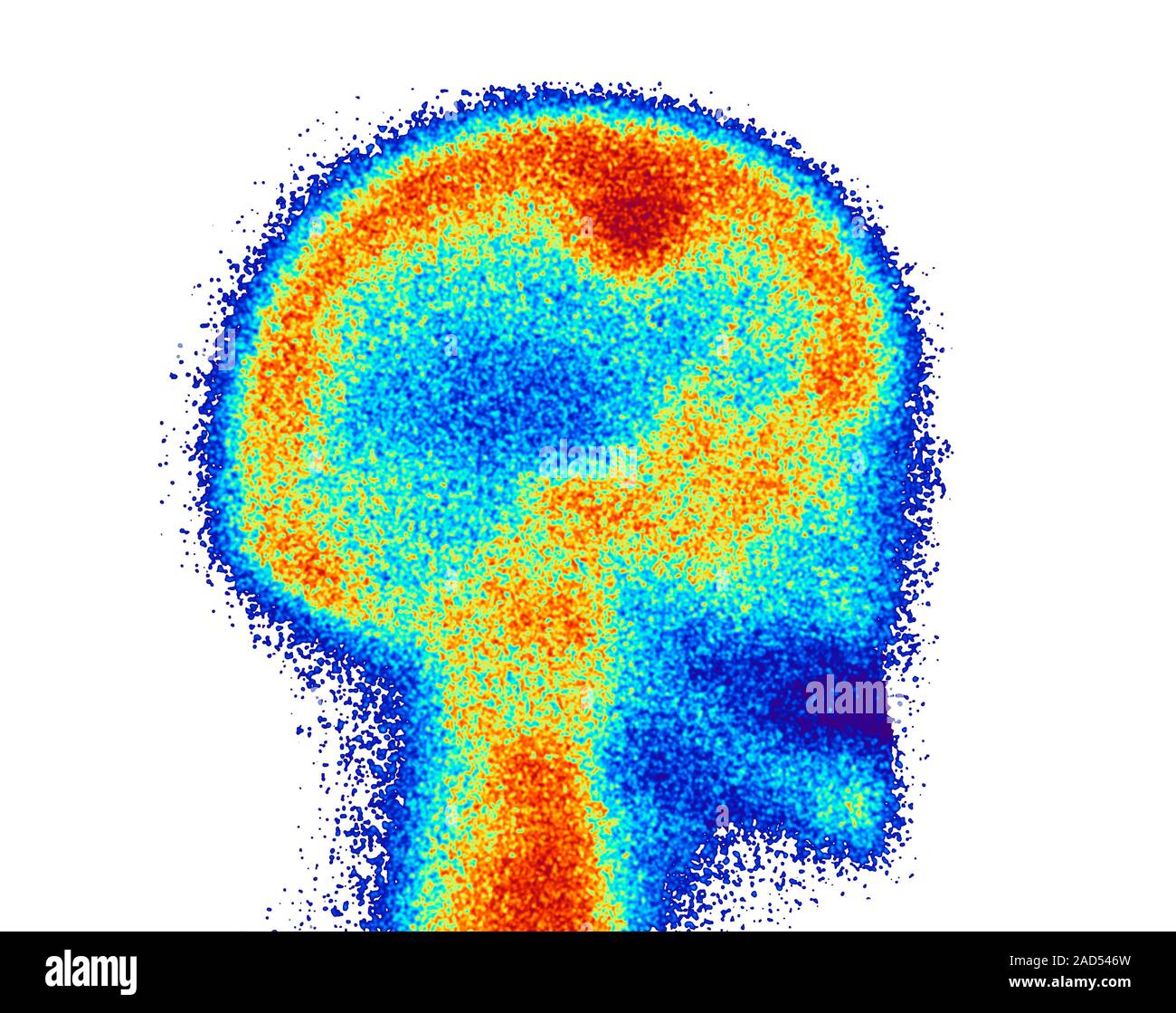 Farbige Knochen szintigraphie eines Kopf, ein Tumor (osteomeningioma, top, dichten roten Fleck). Ein Knochen Scan oder Knochen Szintigraphie ist eine nukleare Scannen t Stockfoto