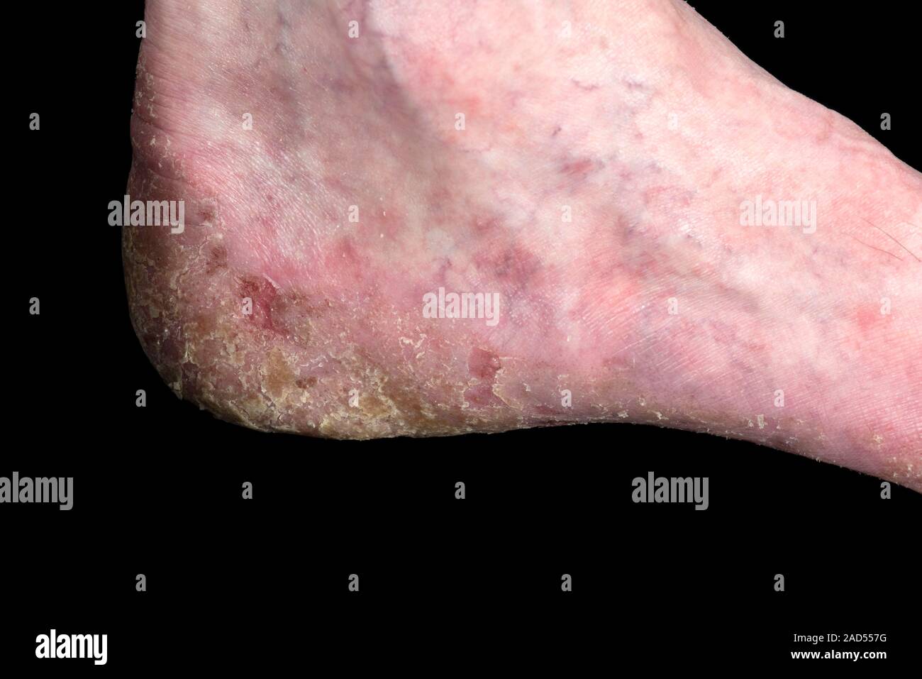 Psoriasis. Psoriasis, die den Fuß eines 70-jährigen männlichen