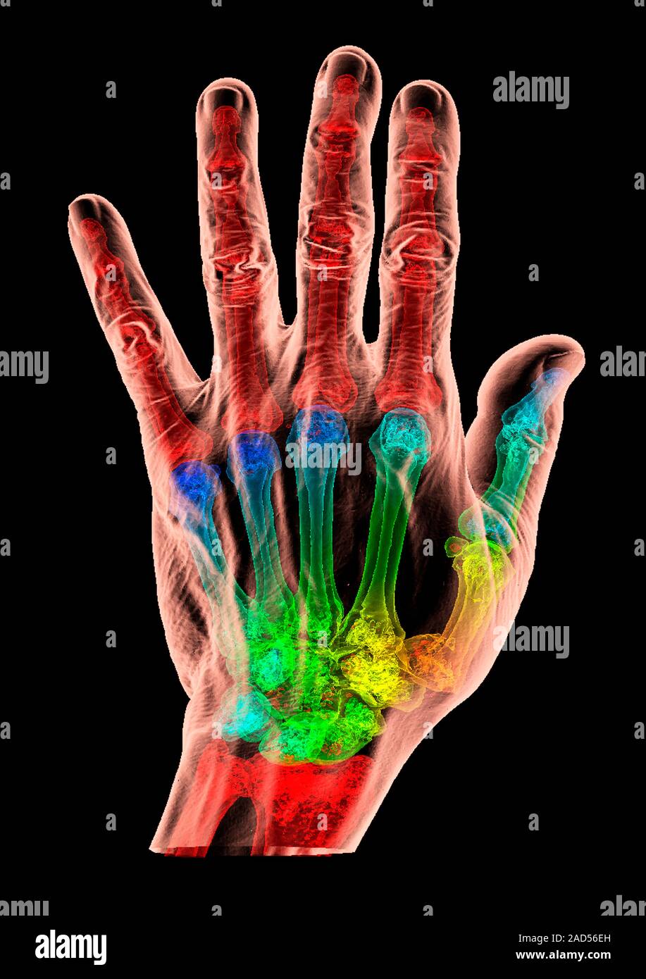 Daumen Bruch. 3D-Computertomographie (CT)-Scan zeigt die Haut und Knochen  im Handgelenk und Hand eines Patienten mit einem vertriebenen Bruch Beei  Stockfotografie - Alamy