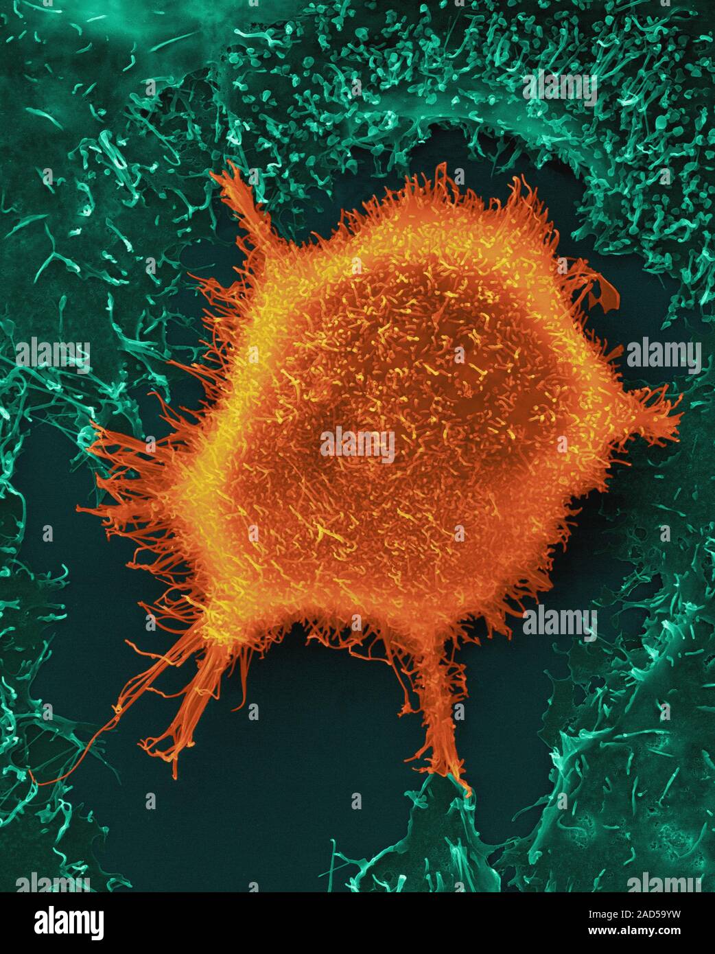 Menschliche Lunge epithelialen Krebszellen unter gesunden Epithelzellen ...