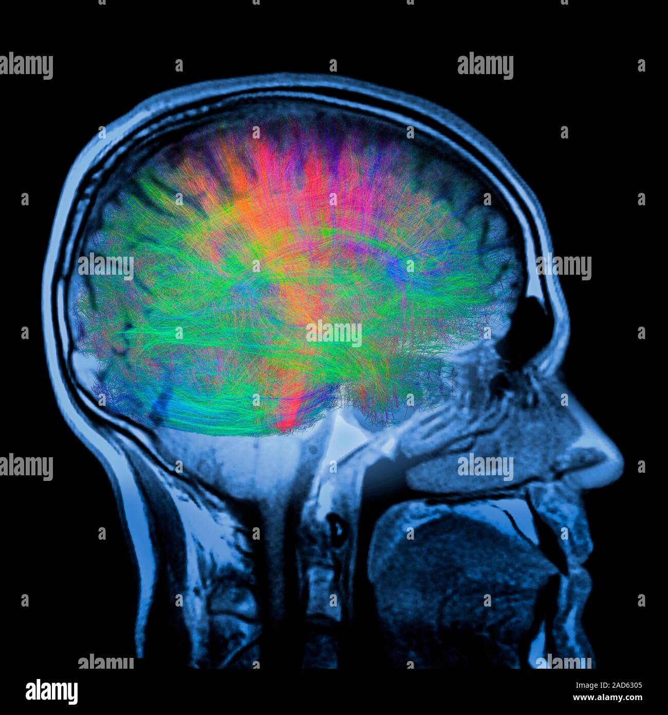 Computer Kunstwerk eines MRT-Ansicht von oben in das Gehirn mit weißen ...