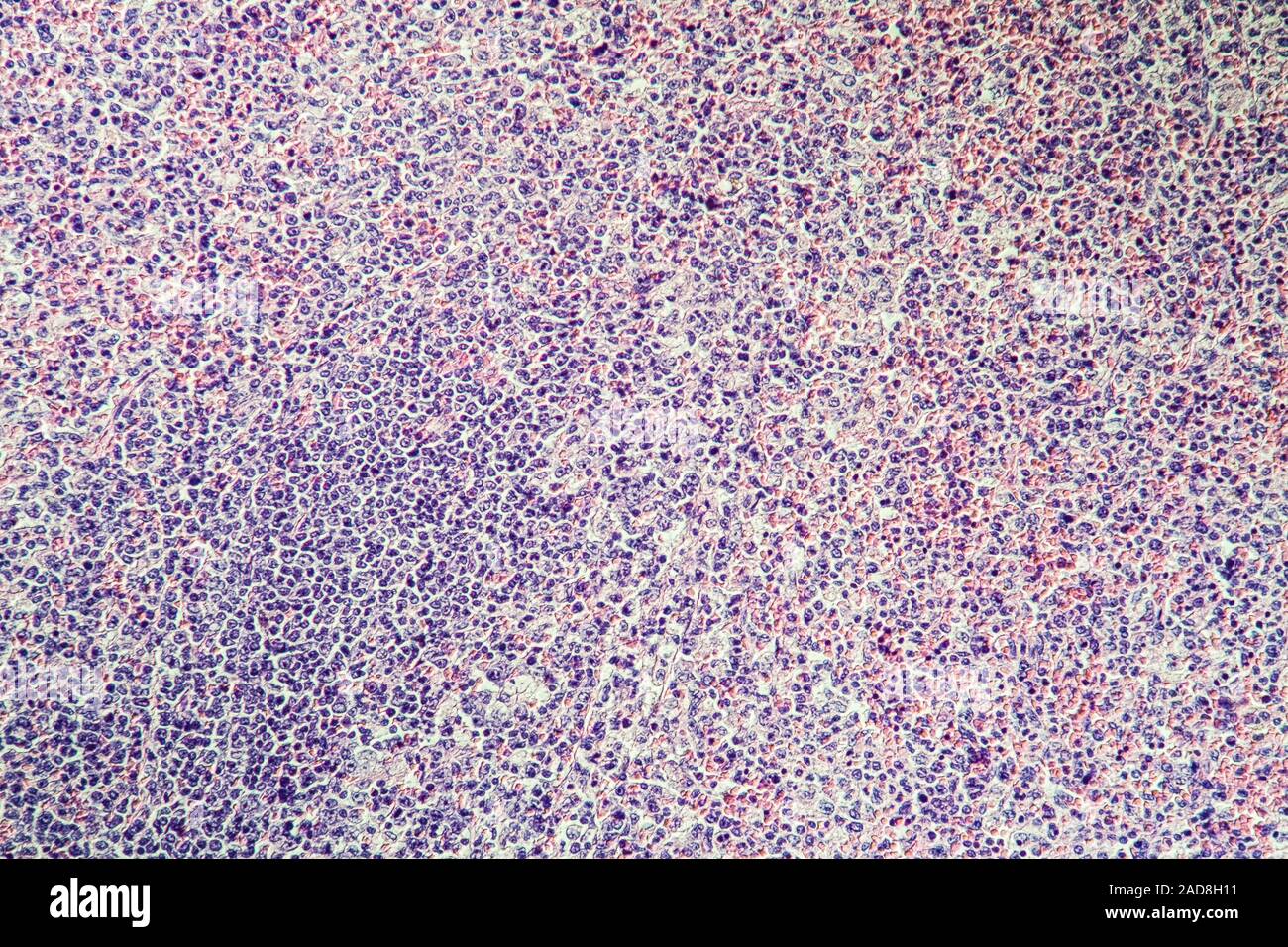 Gasbrand der Leber erkrankte Gewebe unter dem Mikroskop 100x Stockfoto