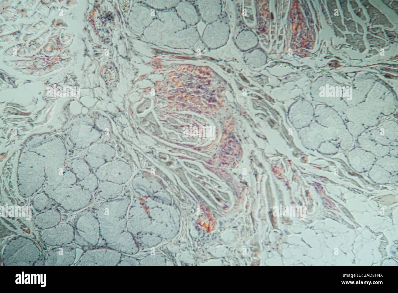 Amyloidablagerungen in der Zunge krankes Gewebe unter dem Mikroskop 200x Stockfoto