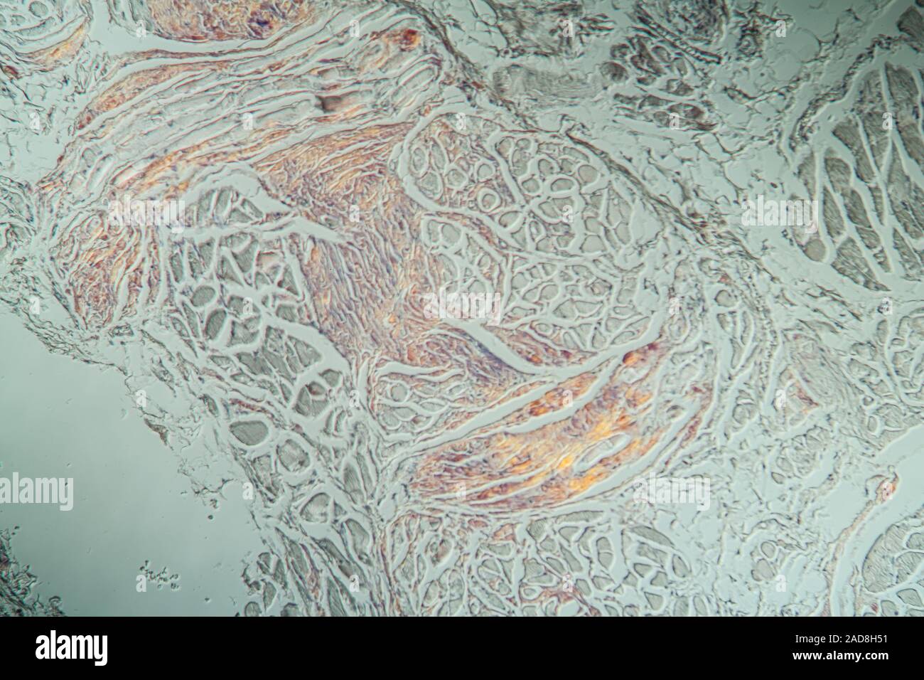 Amyloidablagerungen in der Zunge krankes Gewebe unter dem Mikroskop 200x Stockfoto