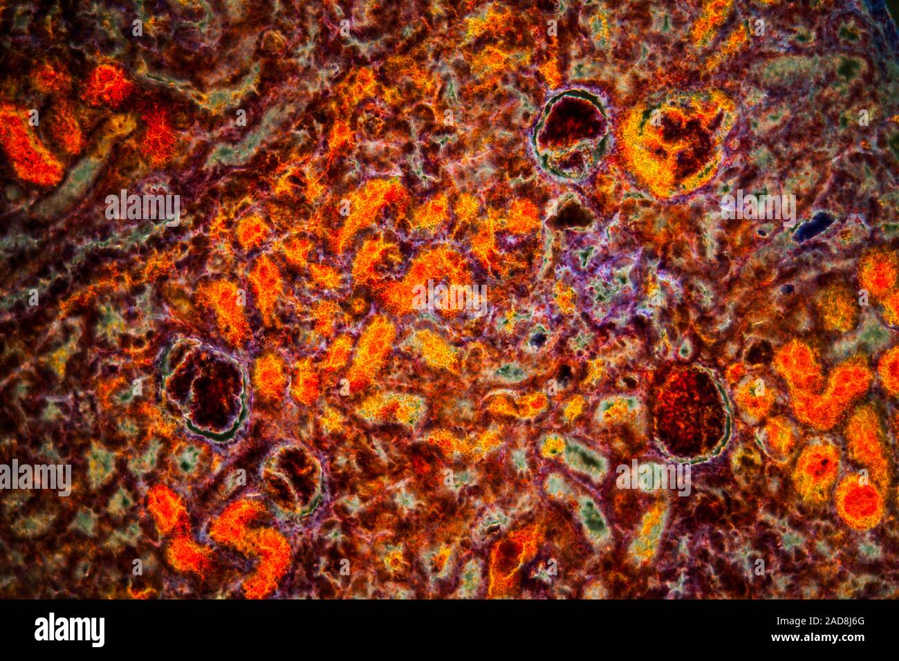 Niere Blutungen krankes Gewebe in den dunklen Bereich unter dem Mikroskop 100x Stockfoto