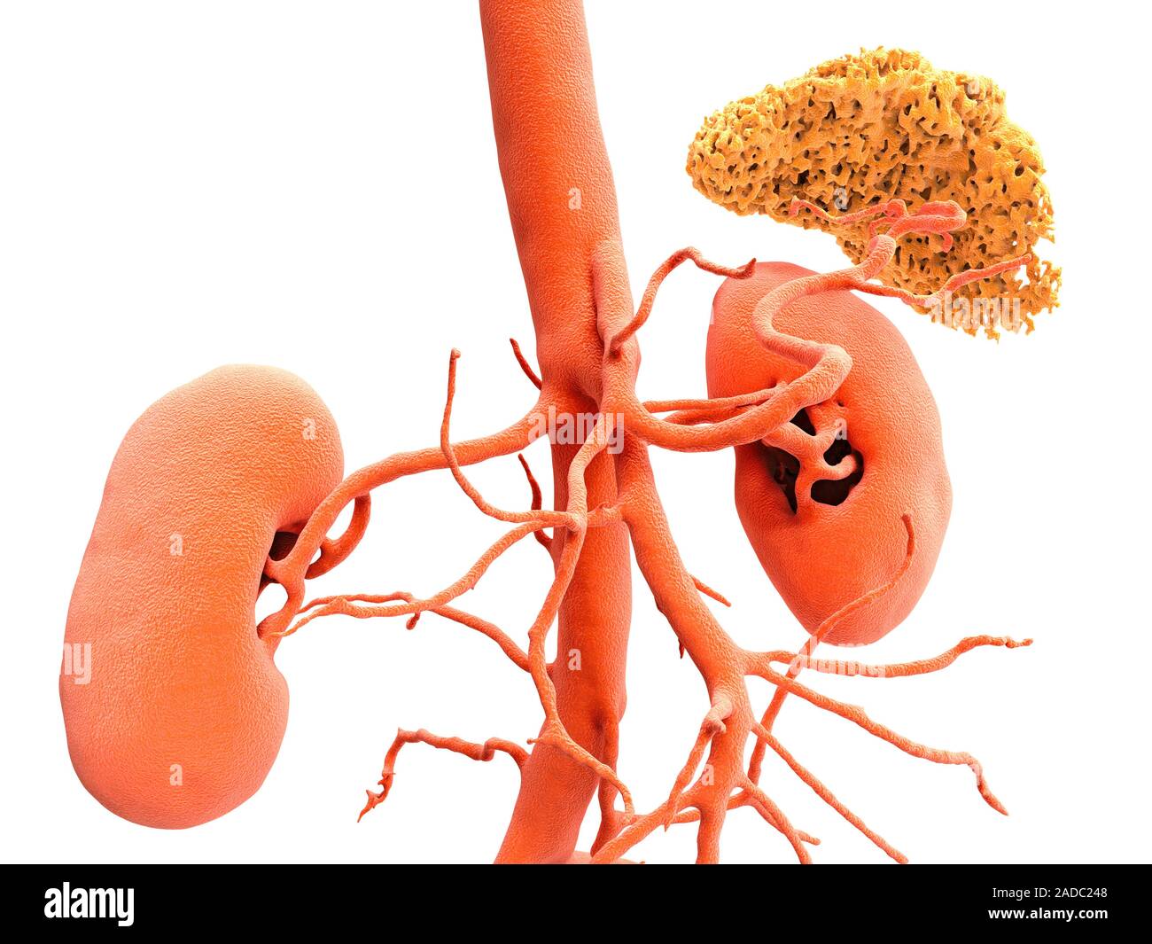 Nieren, CT Scan. Farbige 3-D-Computertomographie (CT) Untersuchung der ...
