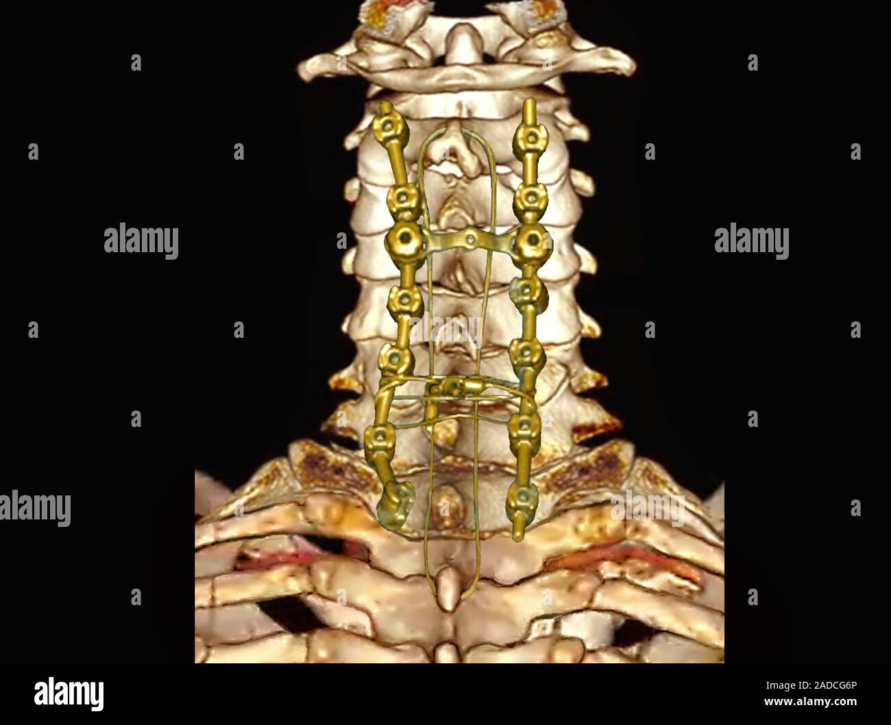 Pinned Hals Wirbel. 3D-Computertomographie (CT)-Scan der spinalen Implantate verwendet eine gebrochene Halswirbel in einem 37-Jahr-alten m Stockfoto