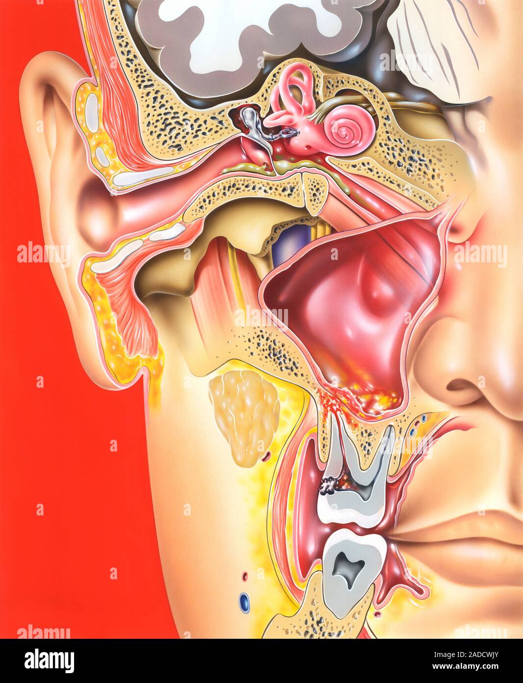 Mittelohr, Zahn und Nebenhöhlenentzündungen. Abbildung: eine Schnittansicht  der rechten Seite des Kopfes, die das Ohr, ein kieferhöhle und zwei Mola  Stockfotografie - Alamy