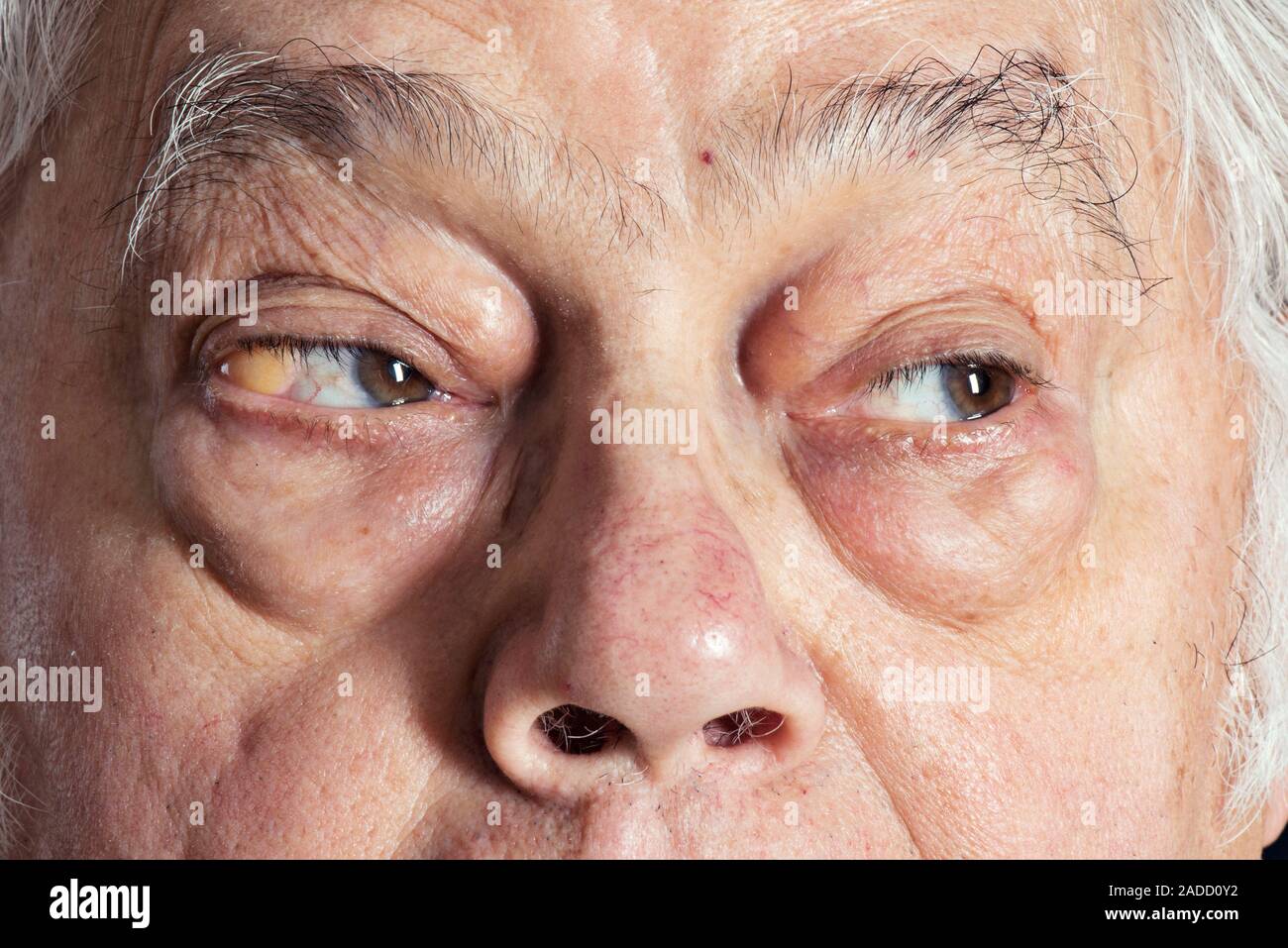Orbital fett Prolaps. Augen von einem 72-jährigen Mann mit subconjunctival  Prolaps der orbitalen Fat (gelb) auf dem rechten Auge (links). In diesem  condit Stockfotografie - Alamy