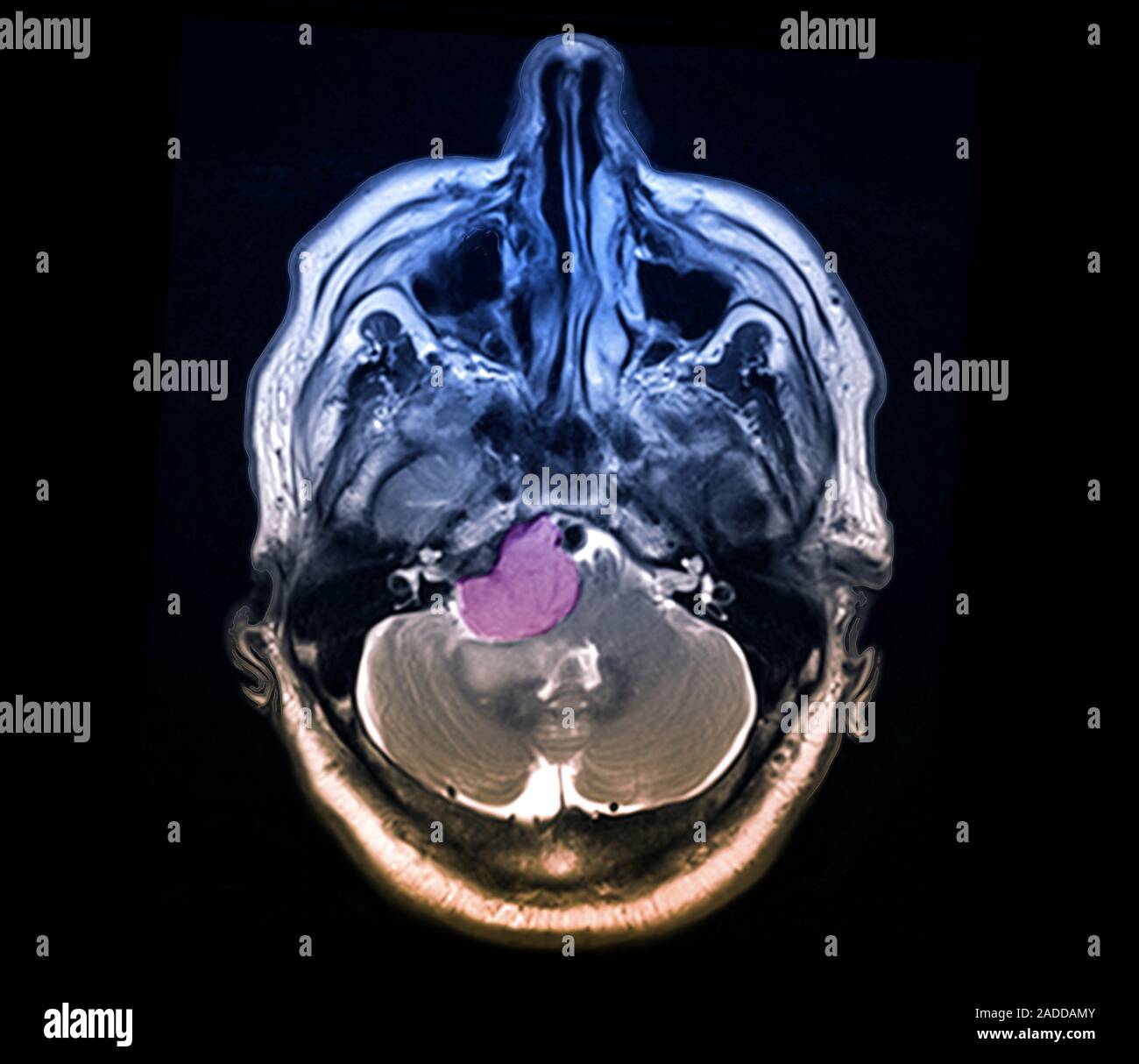 Meningeom Hirntumor. Farbige axial Magnetic Resonance Imaging (MRI