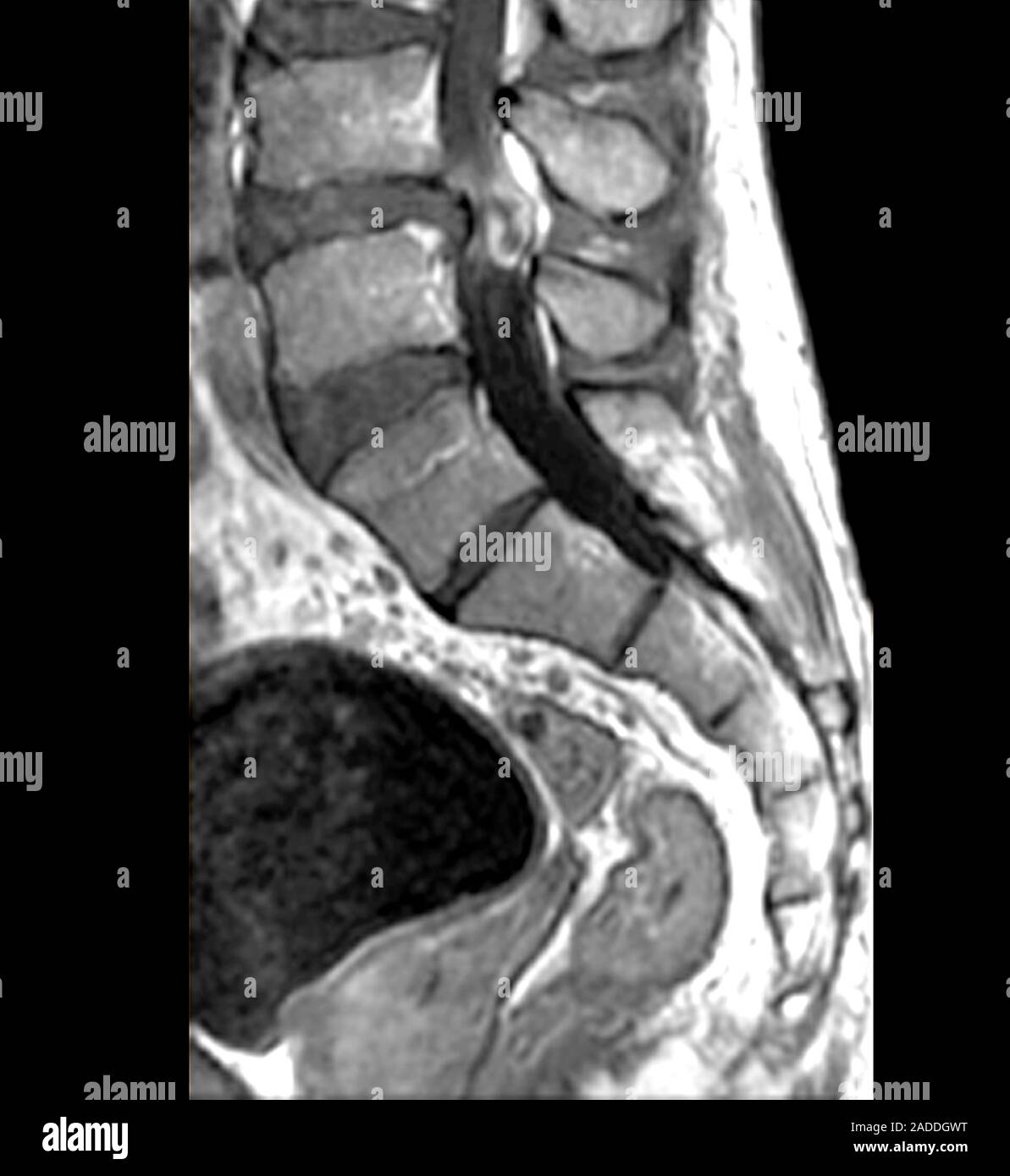 Bandscheibenvorfall in der Lendenwirbelsäule. Sagittale Magnetresonanztomographie (MRT) Scan der Lendenwirbelsäule von einem 39-jährigen Mann mit einem Gerutscht (Bandscheibenvorfall) Ich Stockfoto